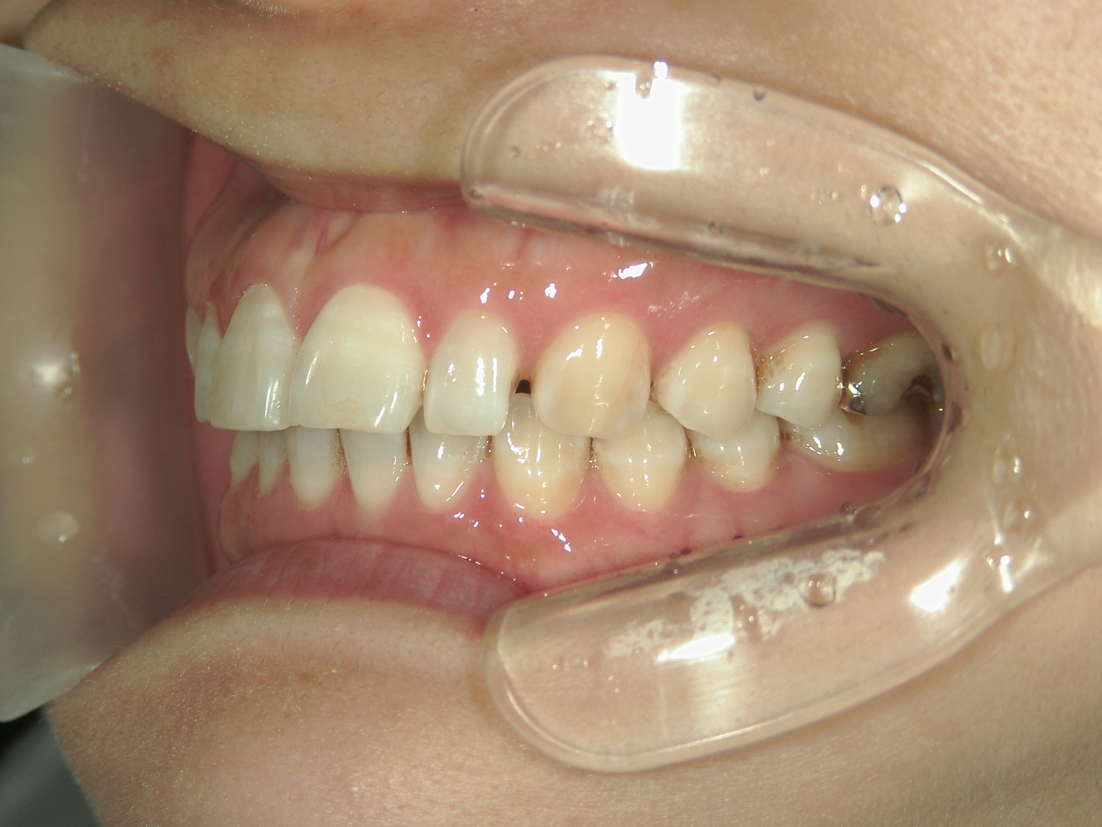 プチ舌側ワイヤー矯正　症例（31）