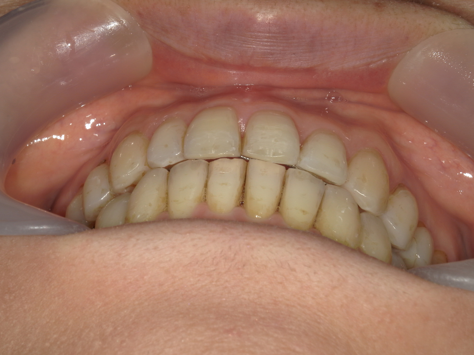 インビザライン矯正　症例（25）