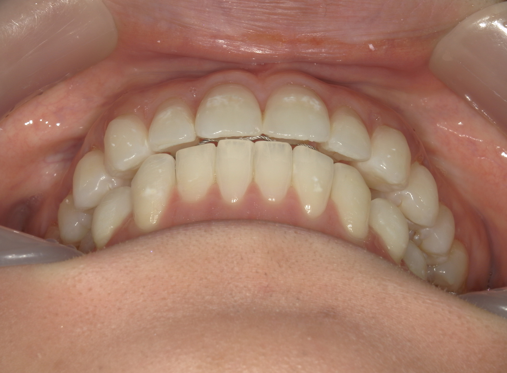 インビザライン矯正　症例（26）