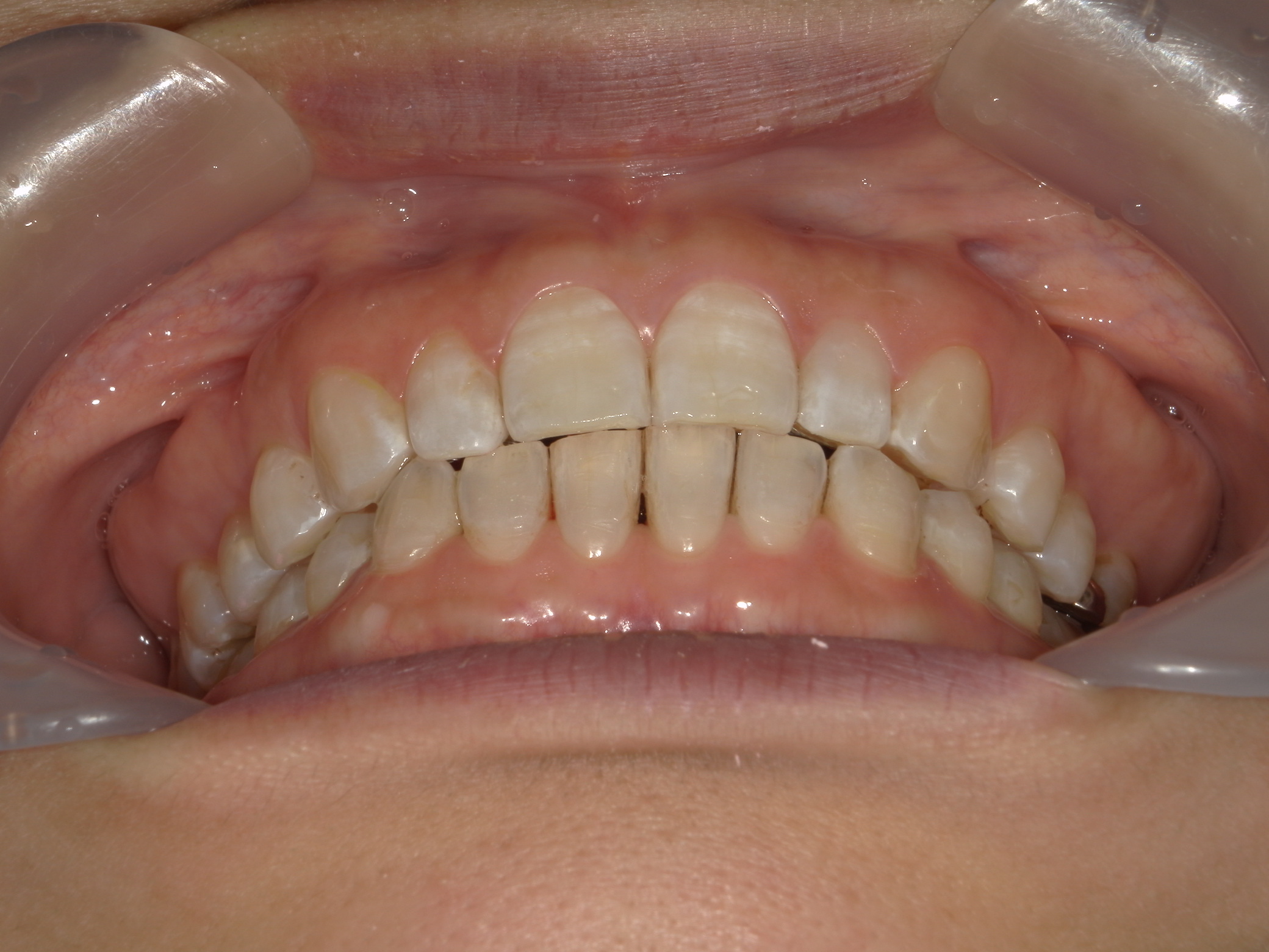 プチ舌側ワイヤー矯正　症例（31）