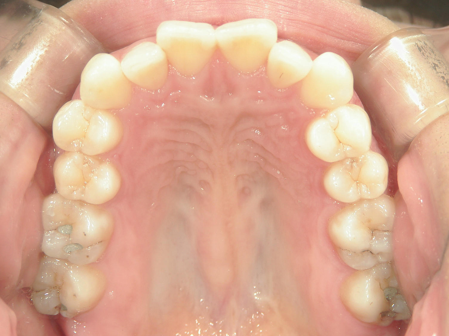 インビザライン矯正　症例（26）