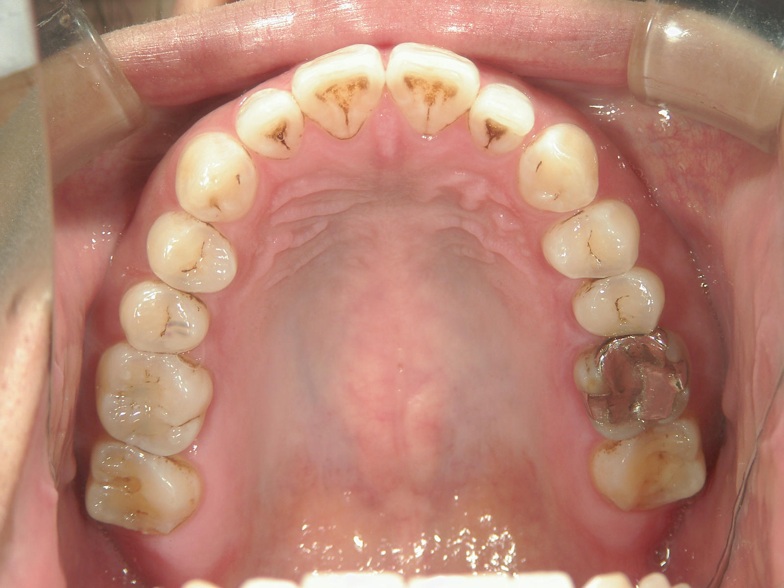 プチ舌側ワイヤー矯正　症例（31）