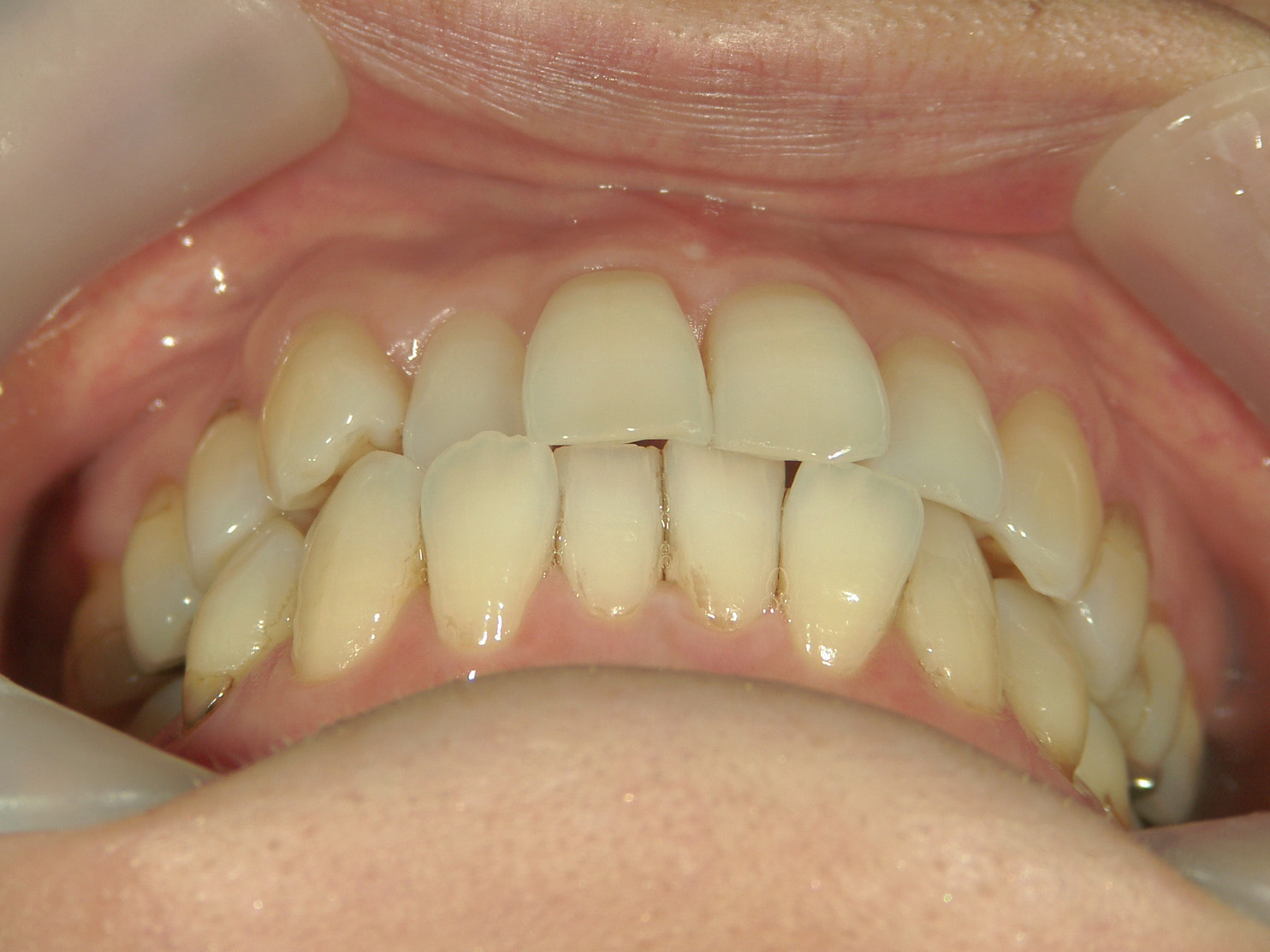 インビザライン矯正　症例（25）