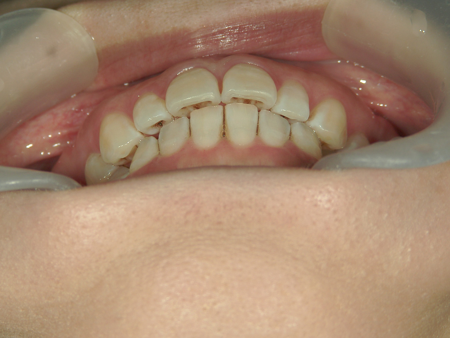 プチ舌側ワイヤー矯正　症例（31）