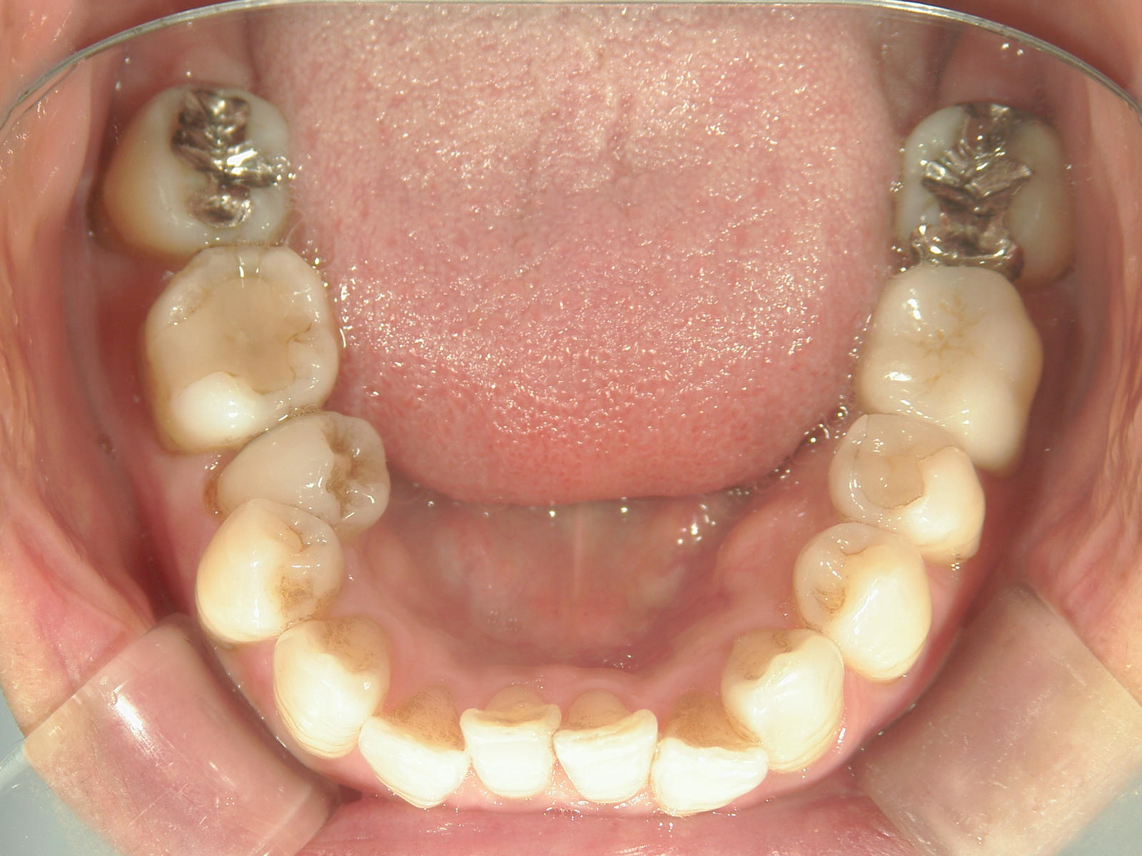 インビザライン矯正　症例（25）