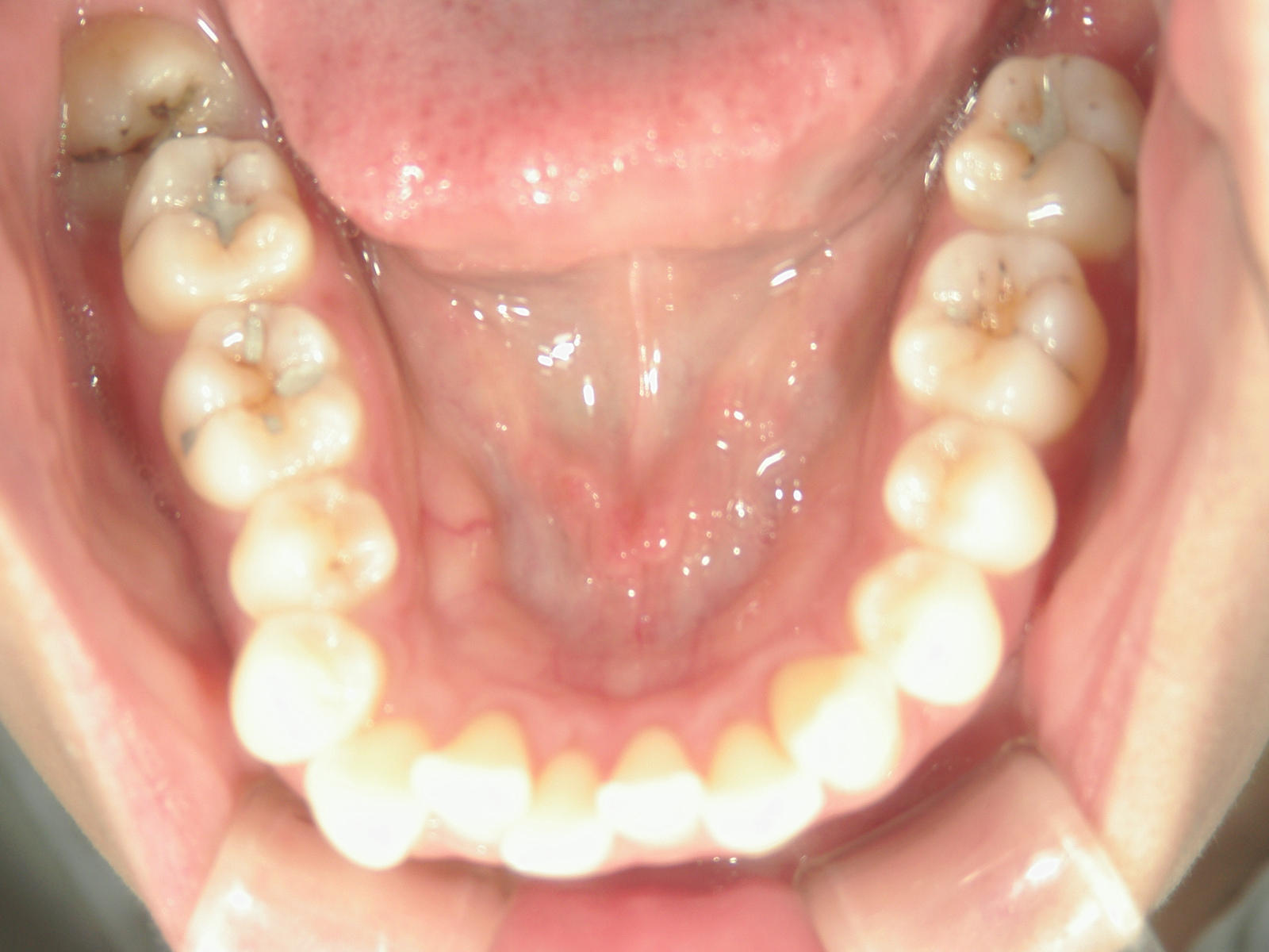 インビザライン矯正　症例（26）