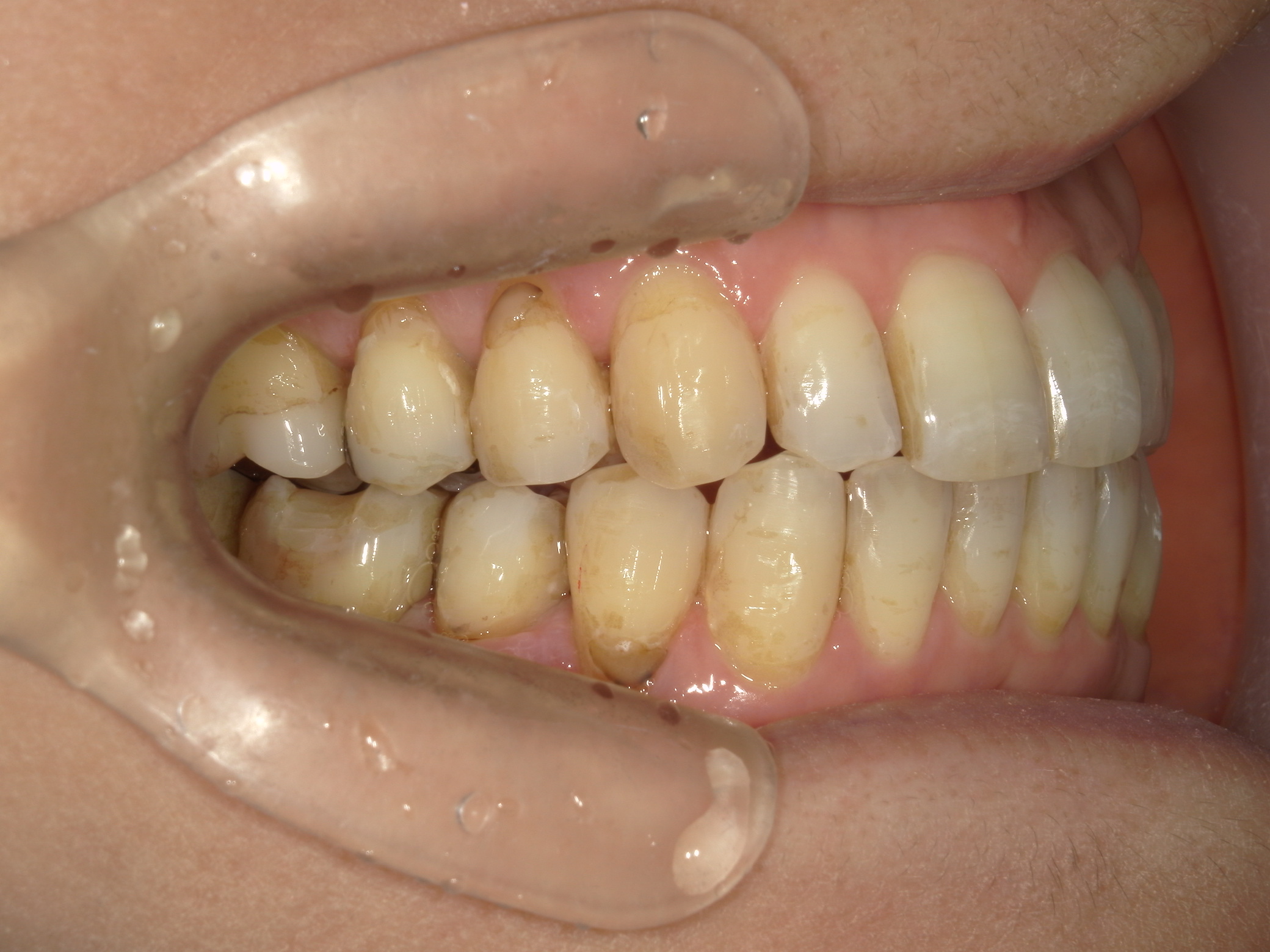 インビザライン矯正　症例（25）