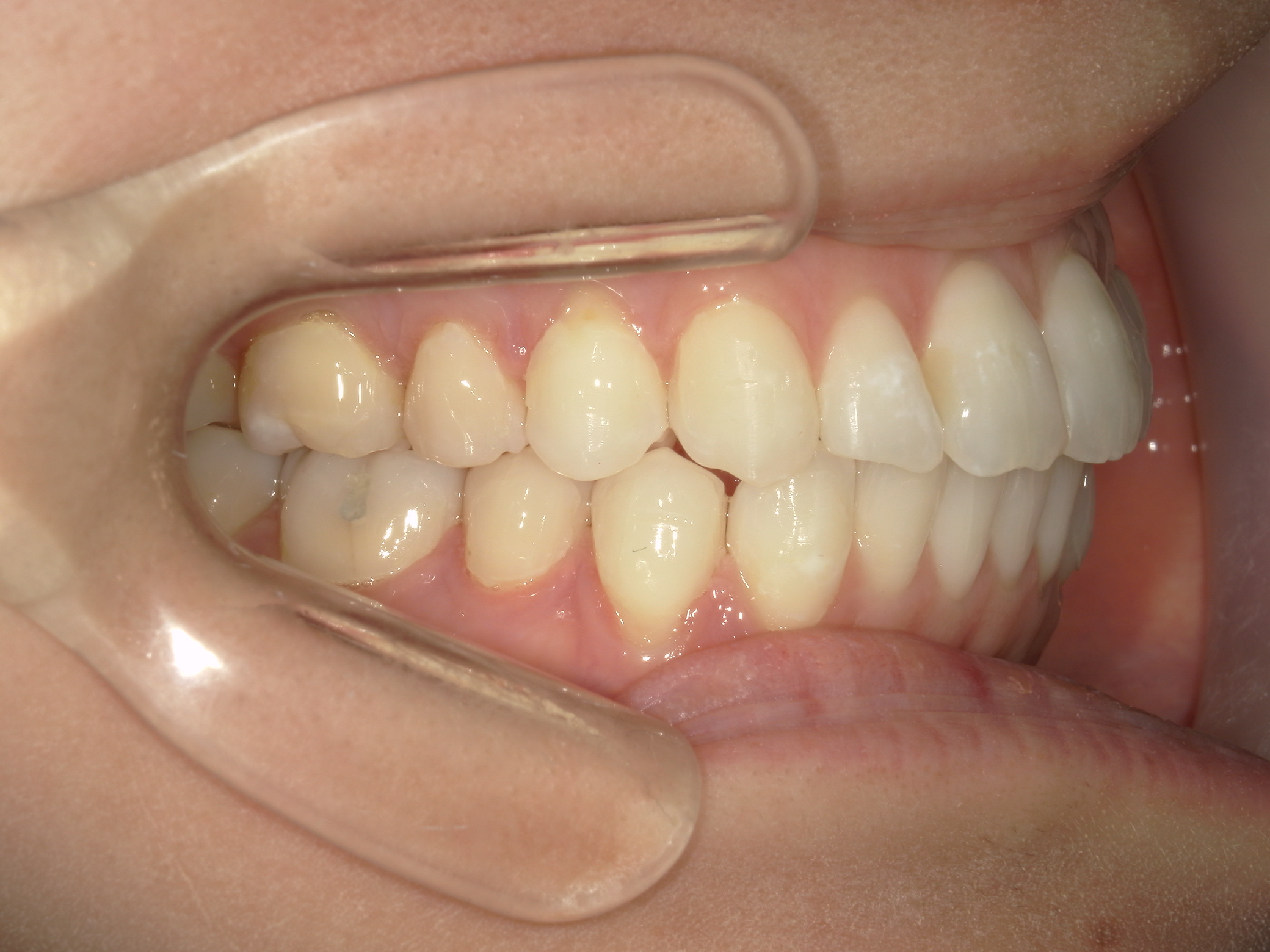 インビザライン矯正　症例（26）