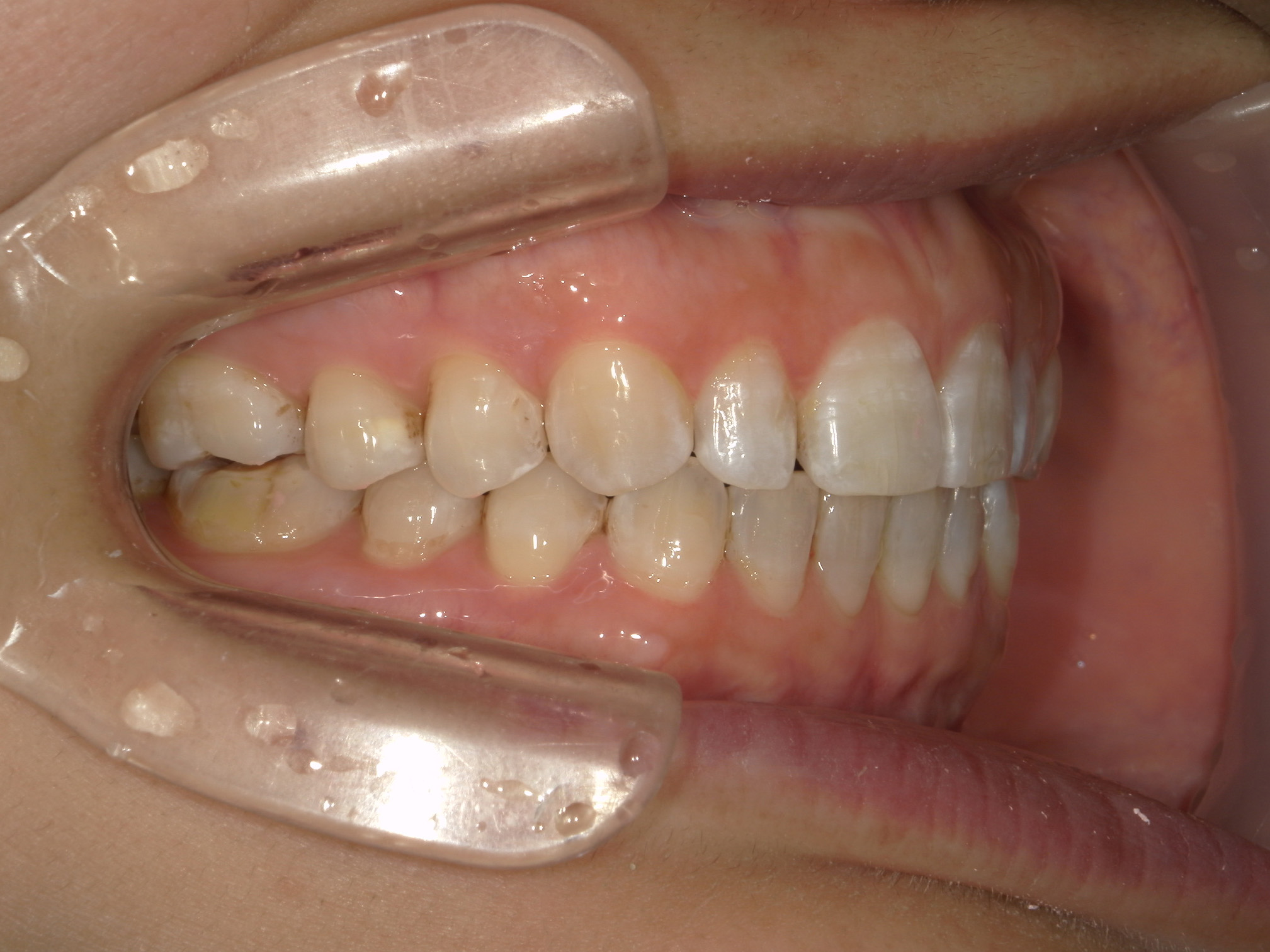 プチ舌側ワイヤー矯正　症例（31）