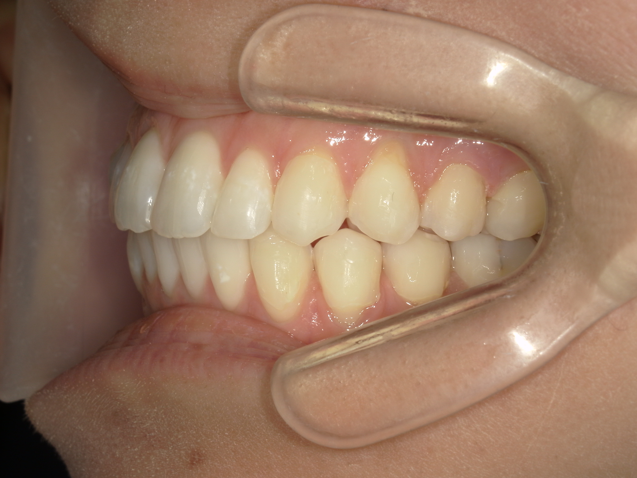 インビザライン矯正　症例（26）