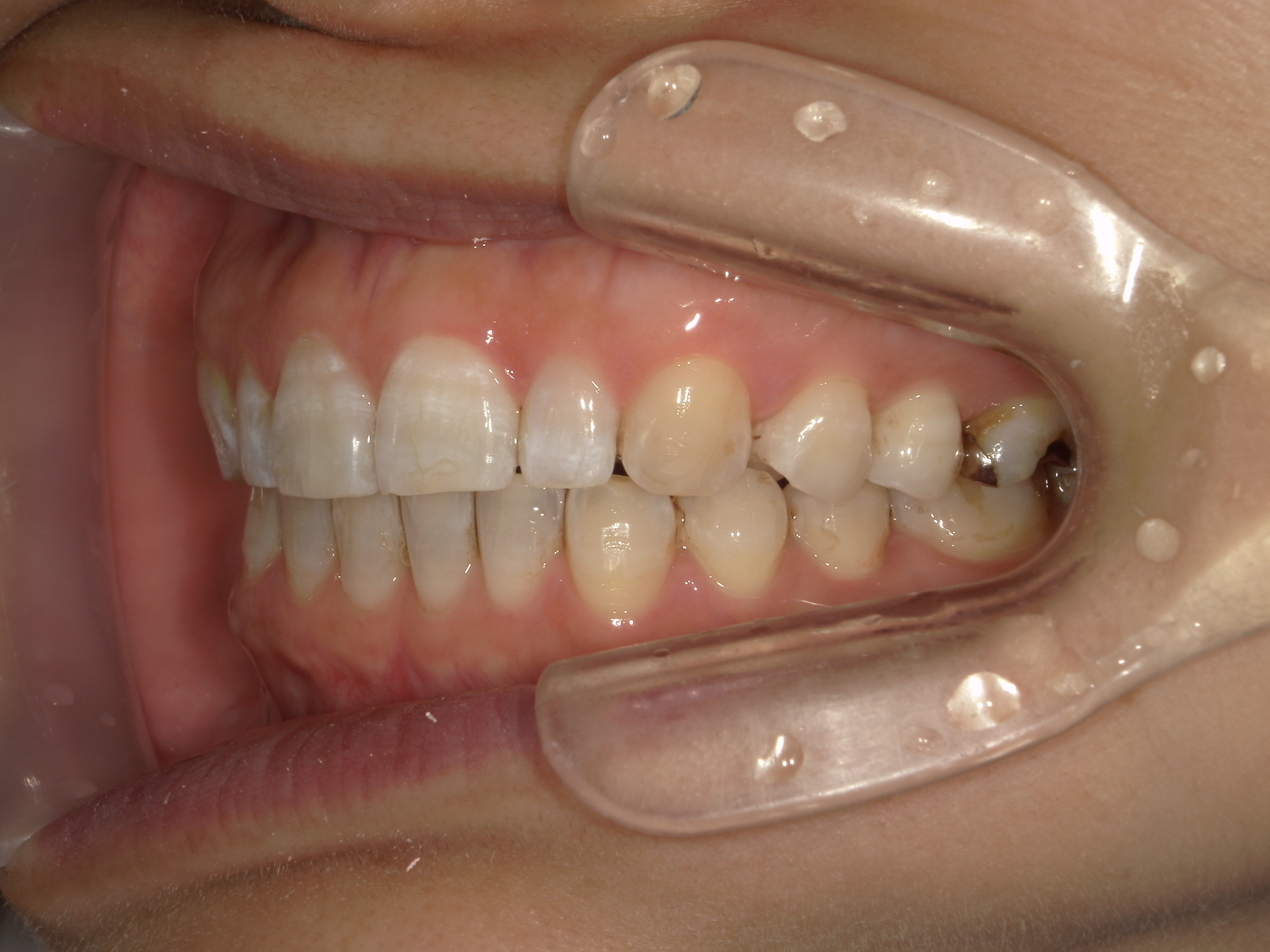プチ舌側ワイヤー矯正　症例（31）