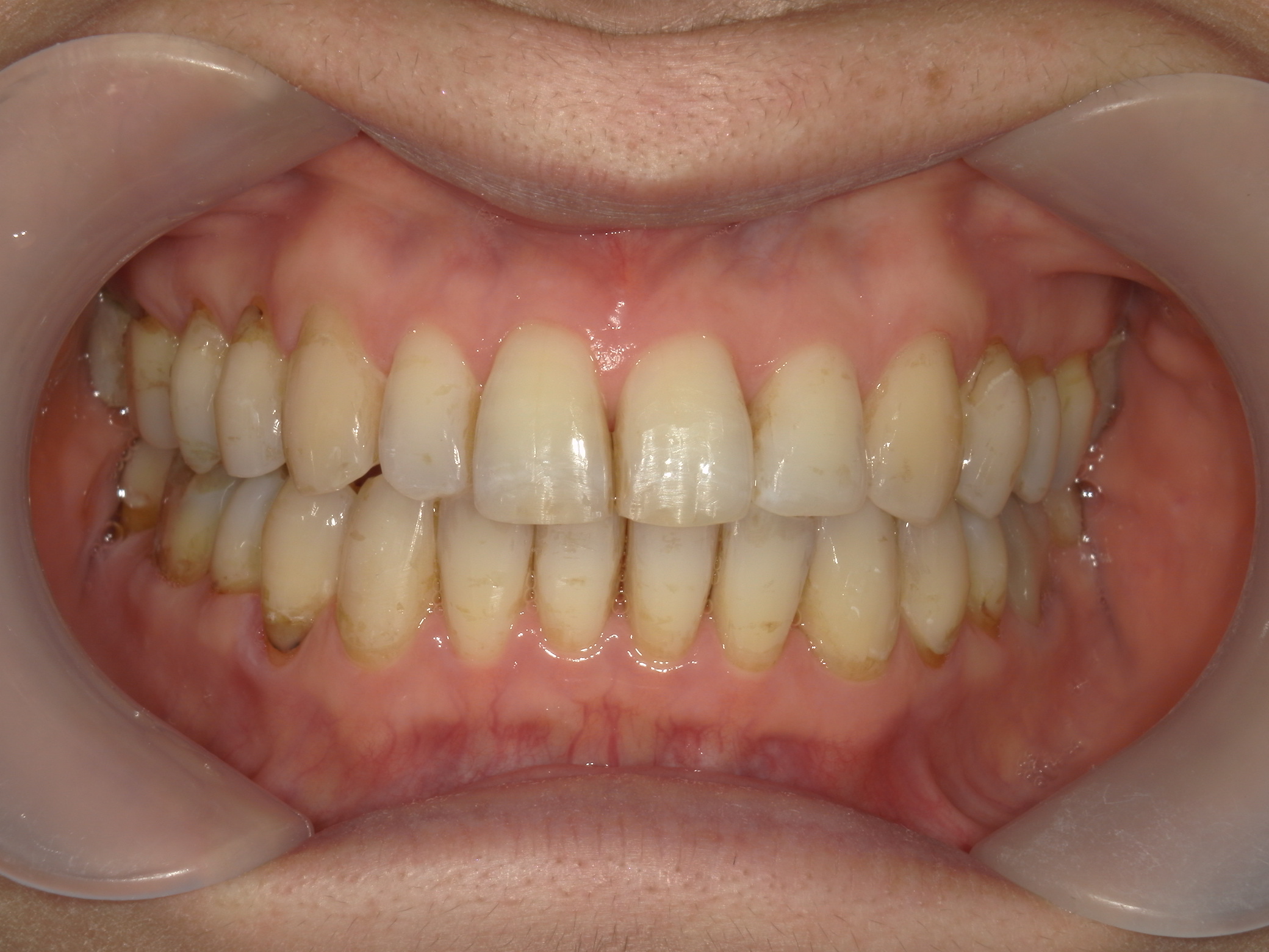 インビザライン矯正　症例（25）