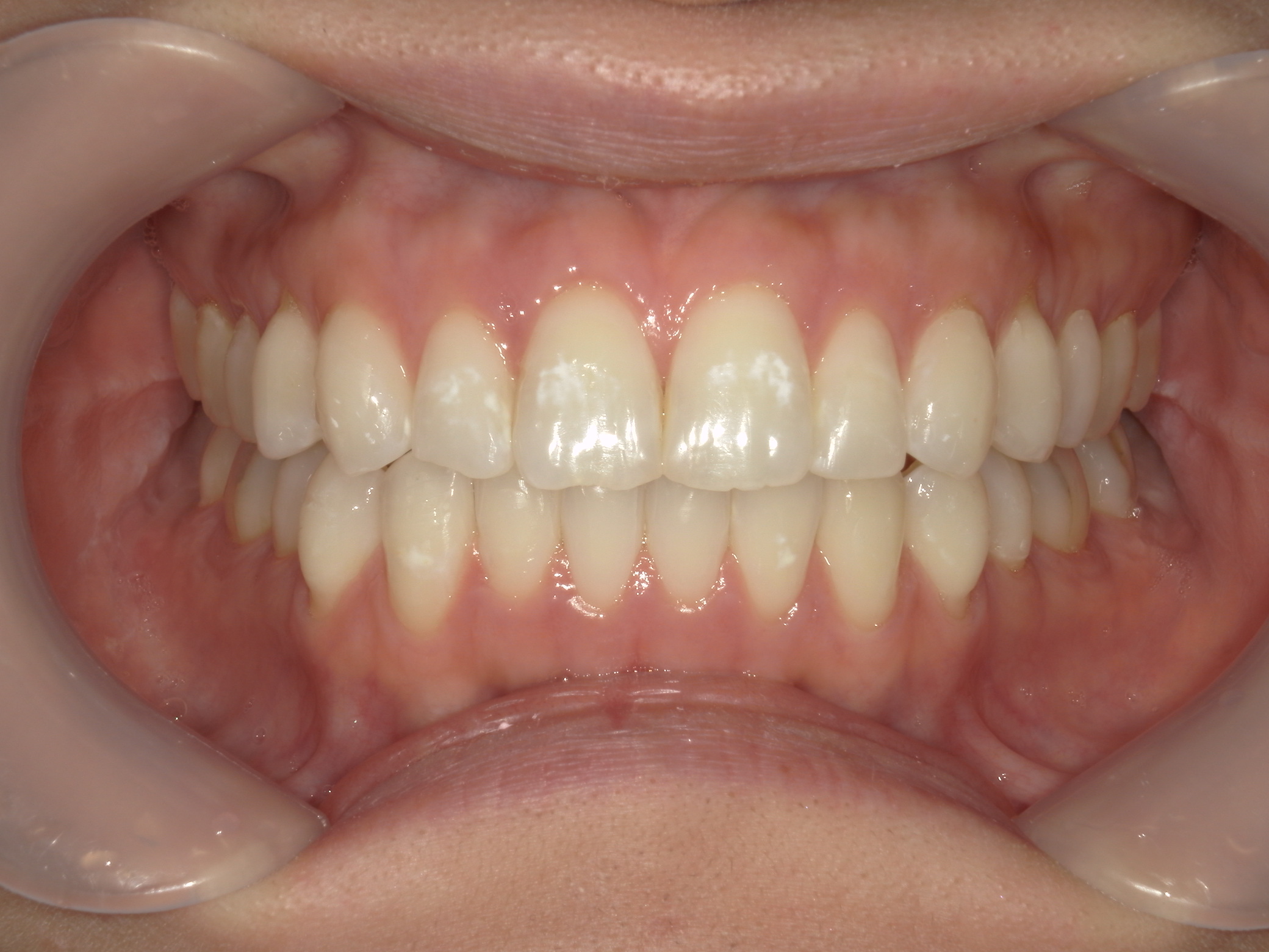 インビザライン矯正　症例（26）