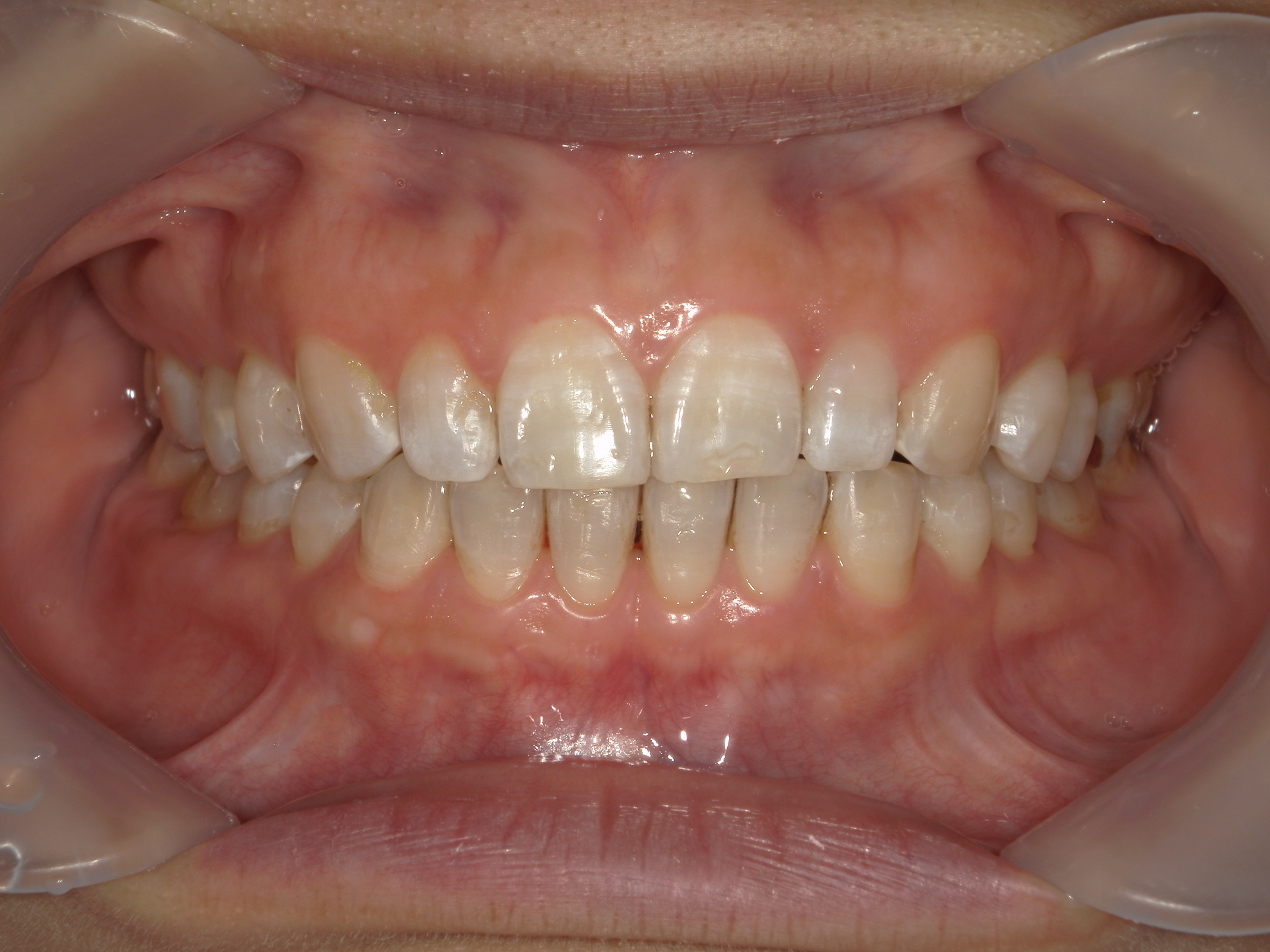 プチ舌側ワイヤー矯正　症例（31）
