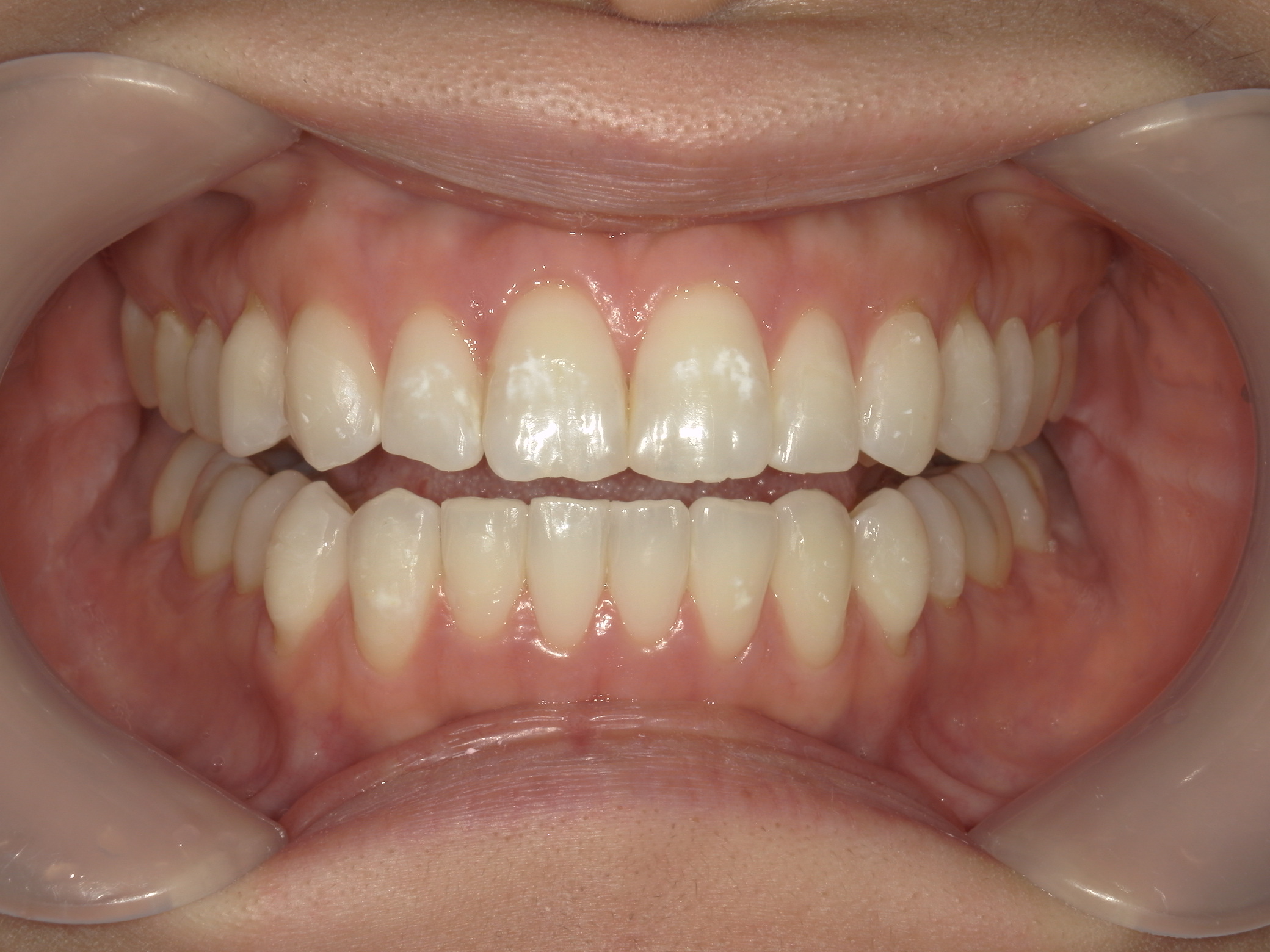 インビザライン矯正　症例（26）