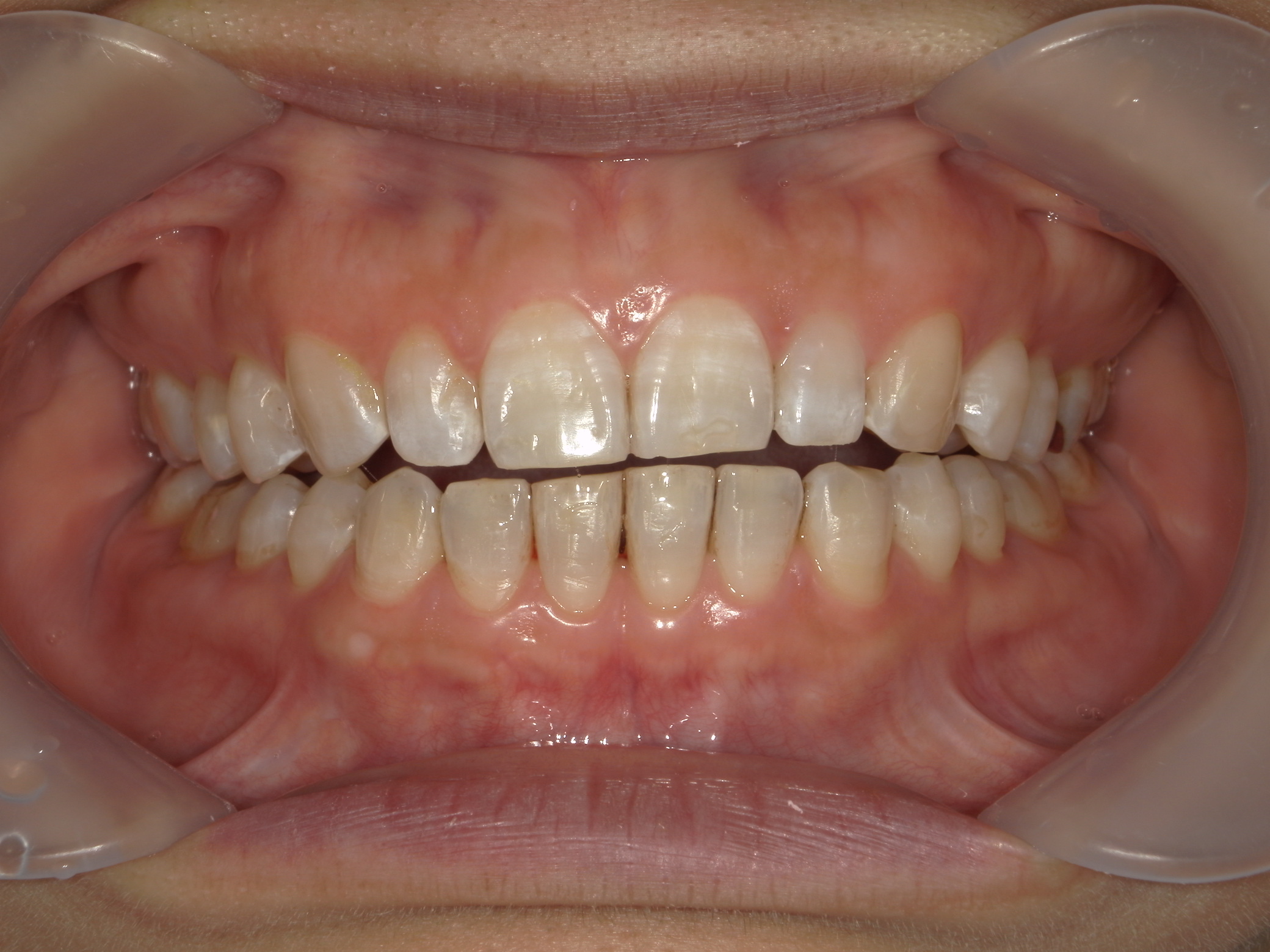 プチ舌側ワイヤー矯正　症例（31）