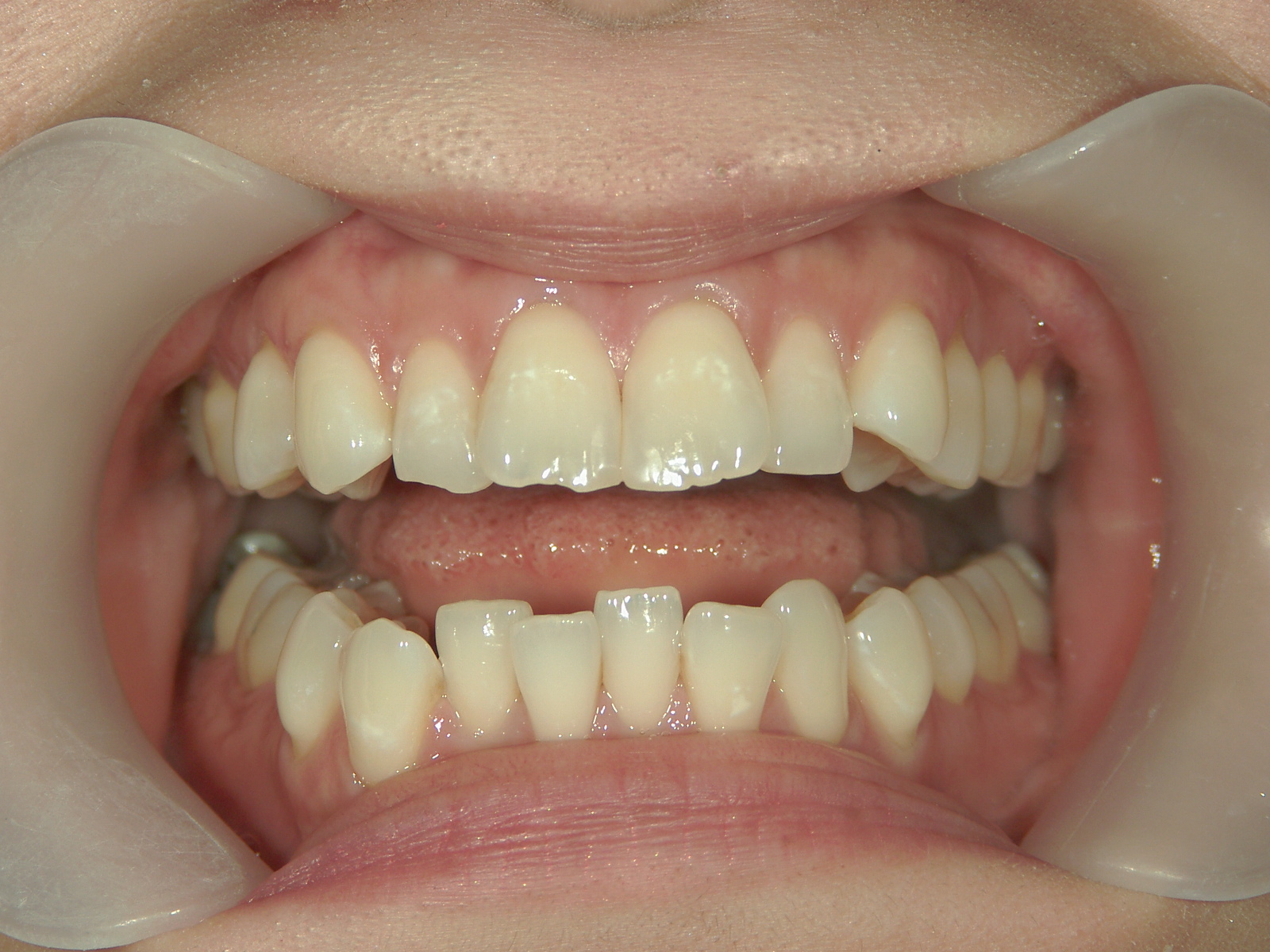 インビザライン矯正　症例（26）