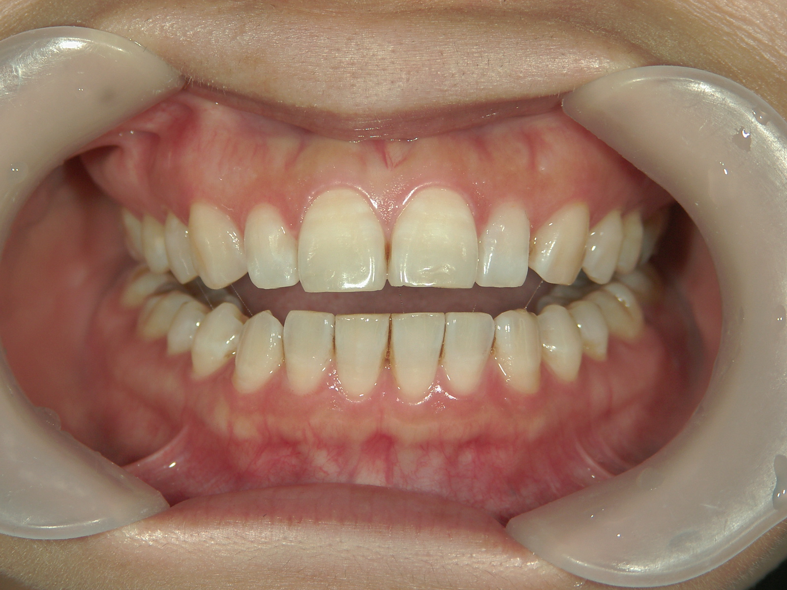 プチ舌側ワイヤー矯正　症例（31）