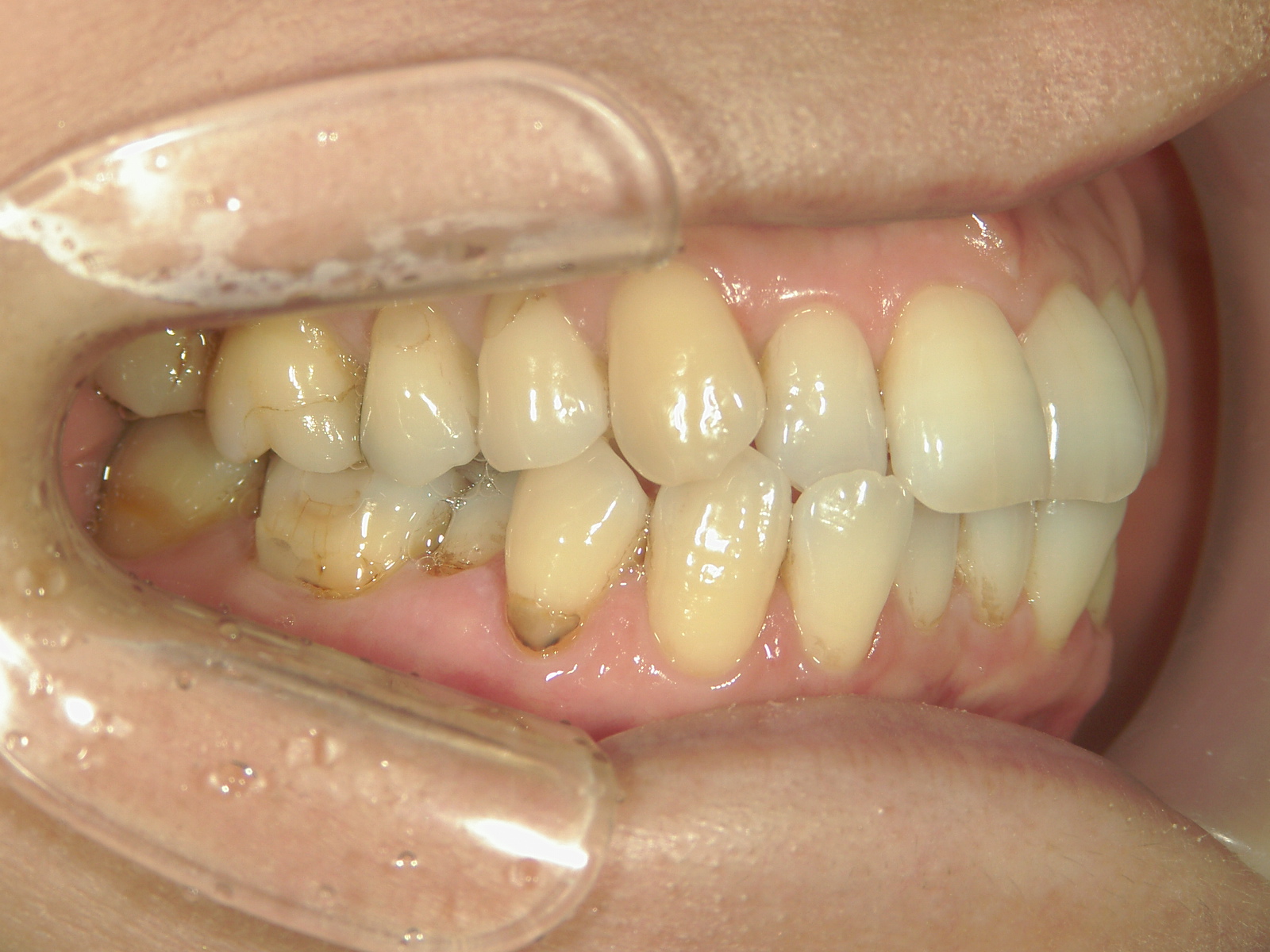 インビザライン矯正　症例（25）