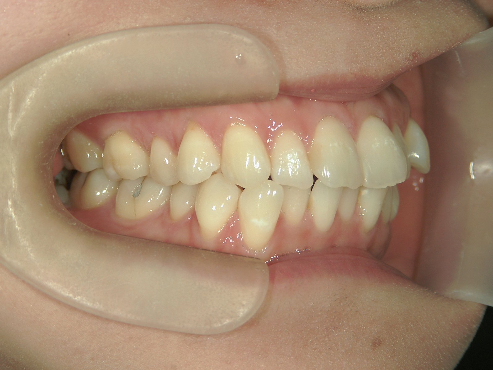 インビザライン矯正　症例（26）