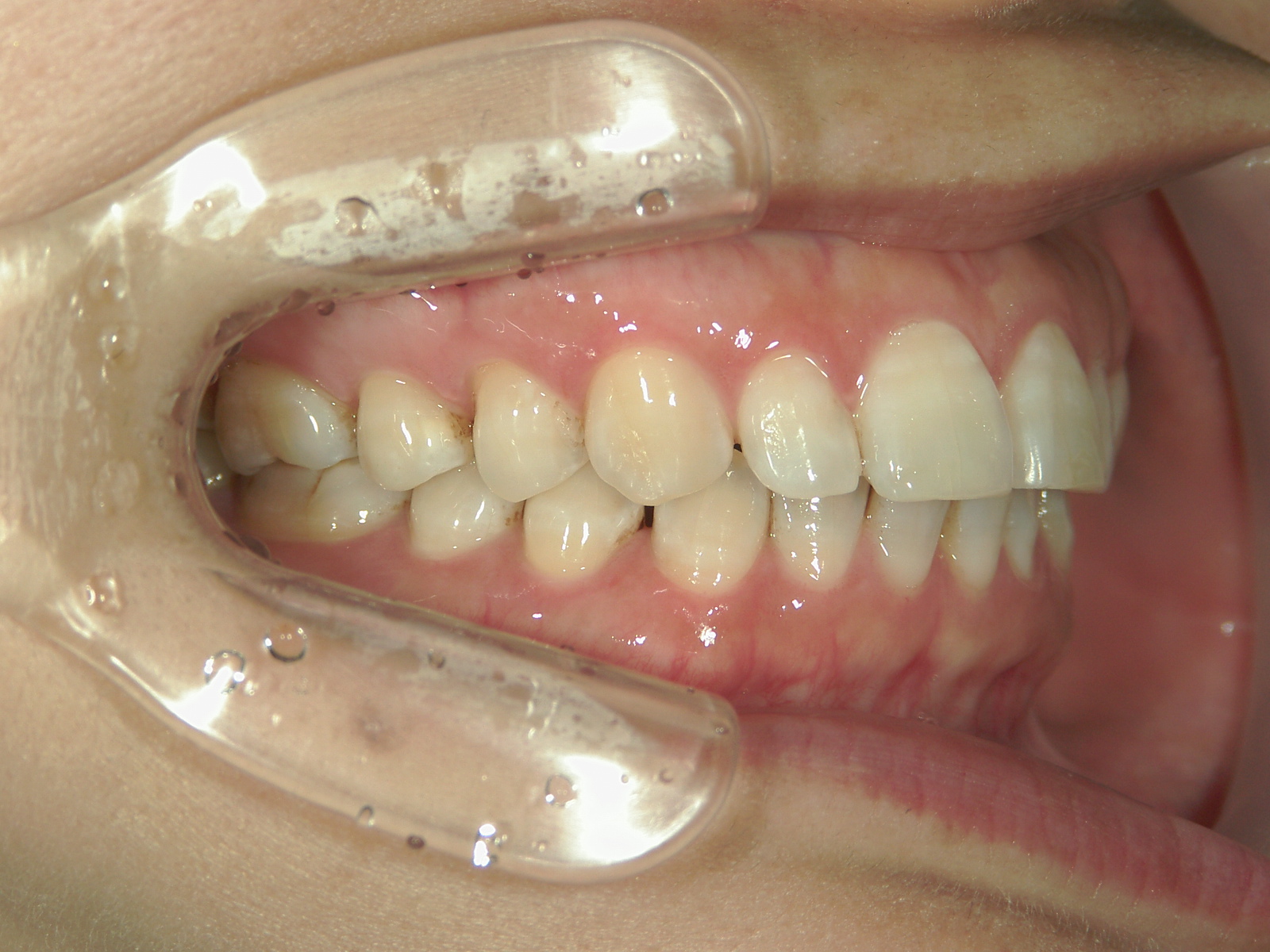 プチ舌側ワイヤー矯正　症例（31）