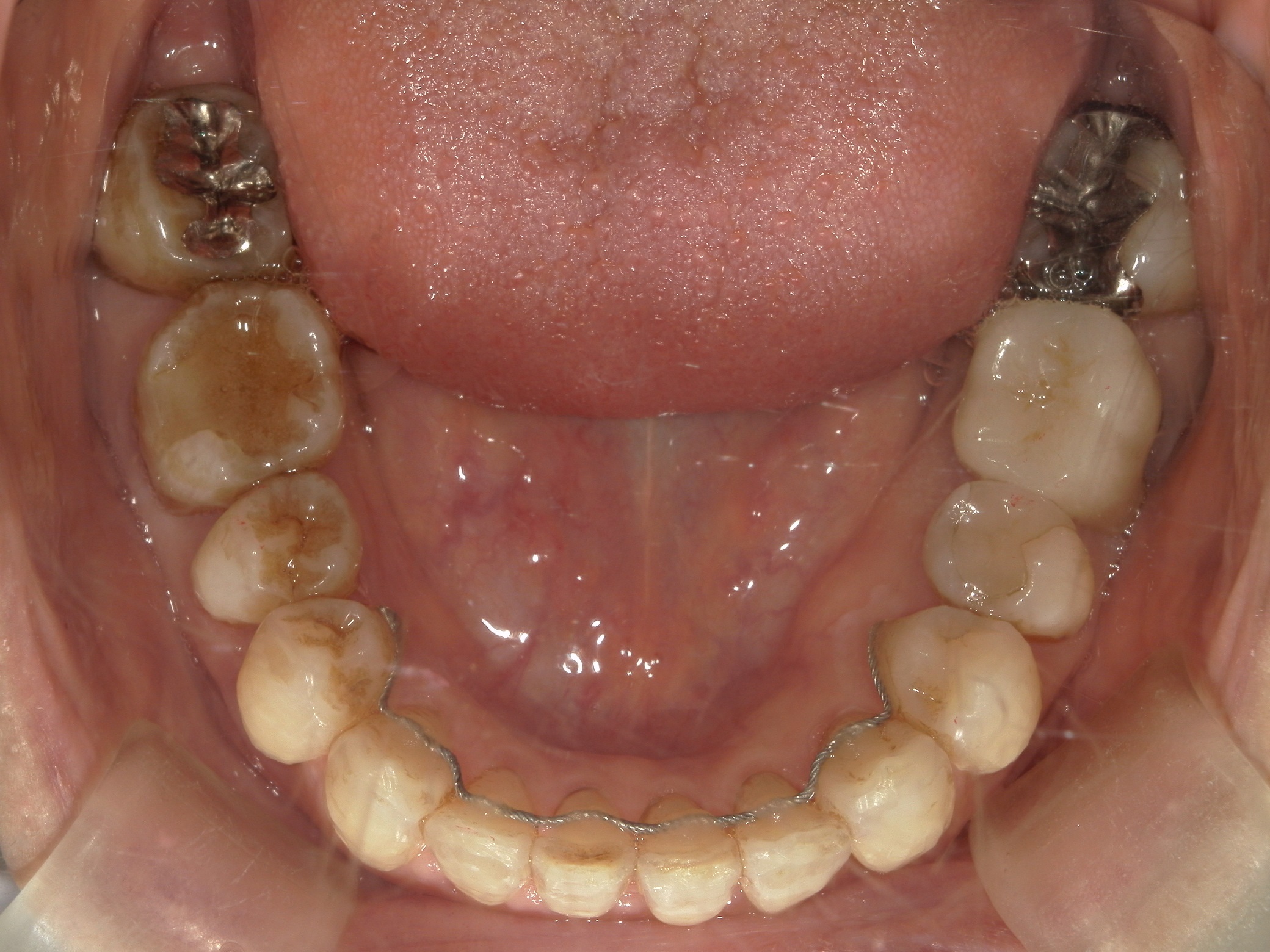 インビザライン矯正　症例（25）