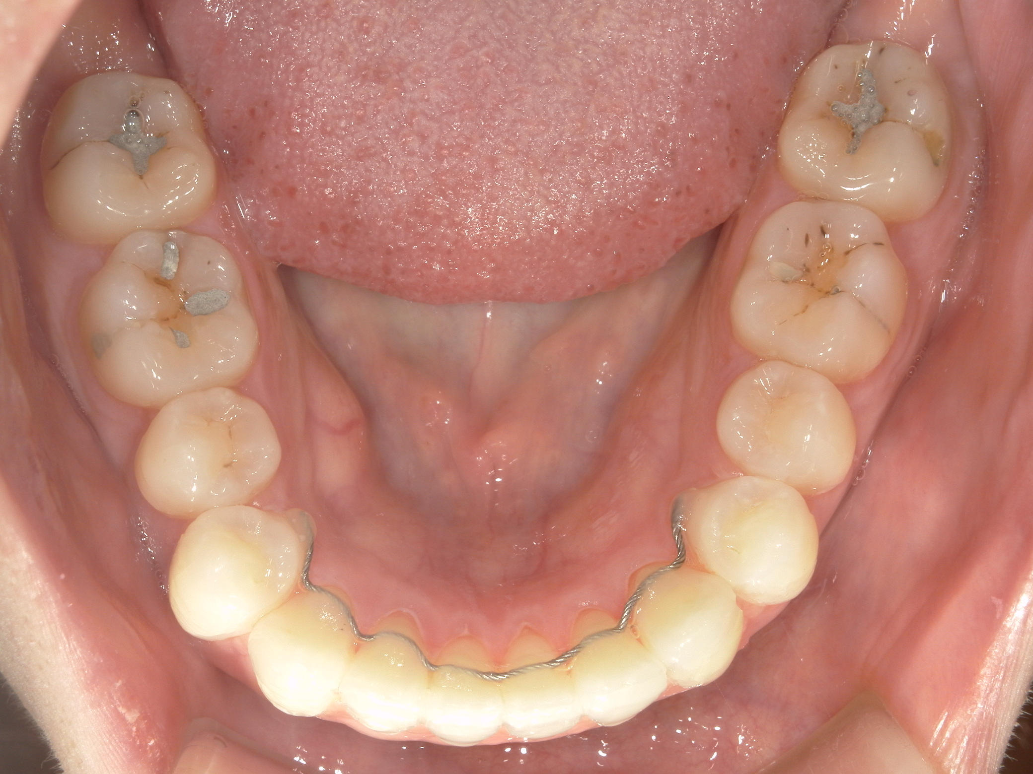 インビザライン矯正　症例（26）