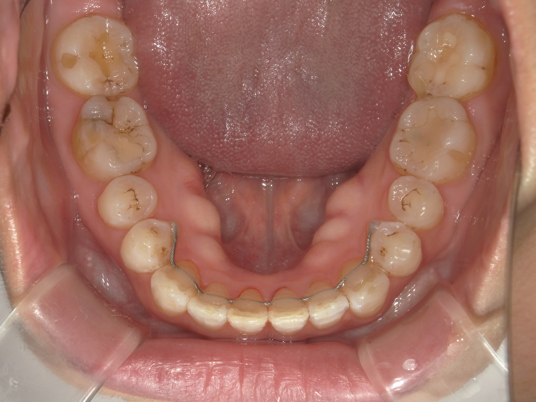プチ舌側ワイヤー矯正　症例（31）