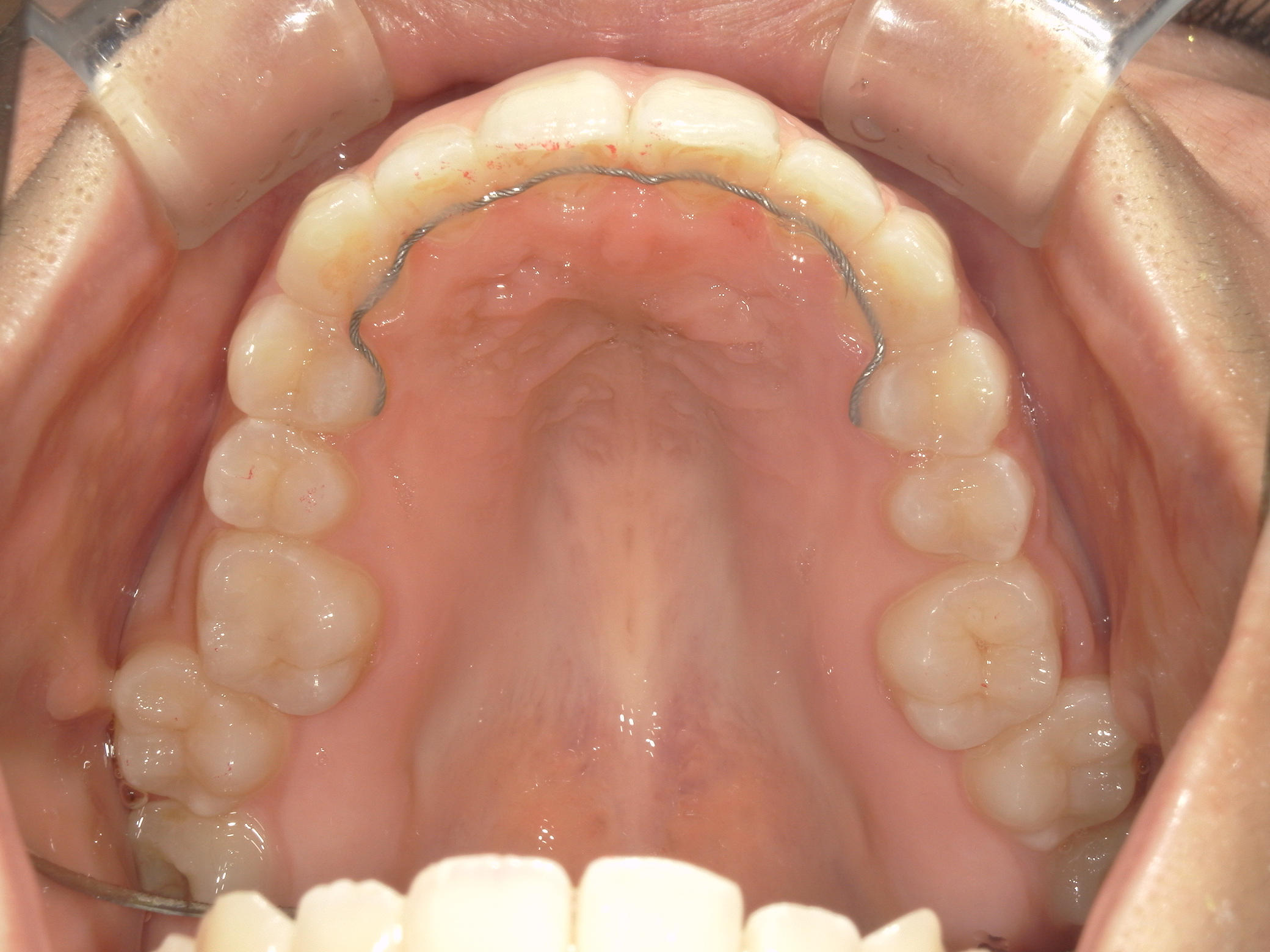 プチワイヤー矯正　症例（54）