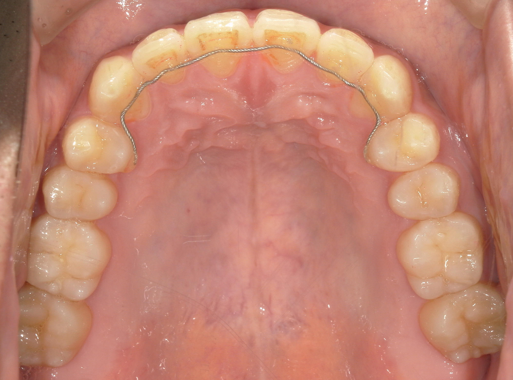 インビザライン矯正　症例（29）