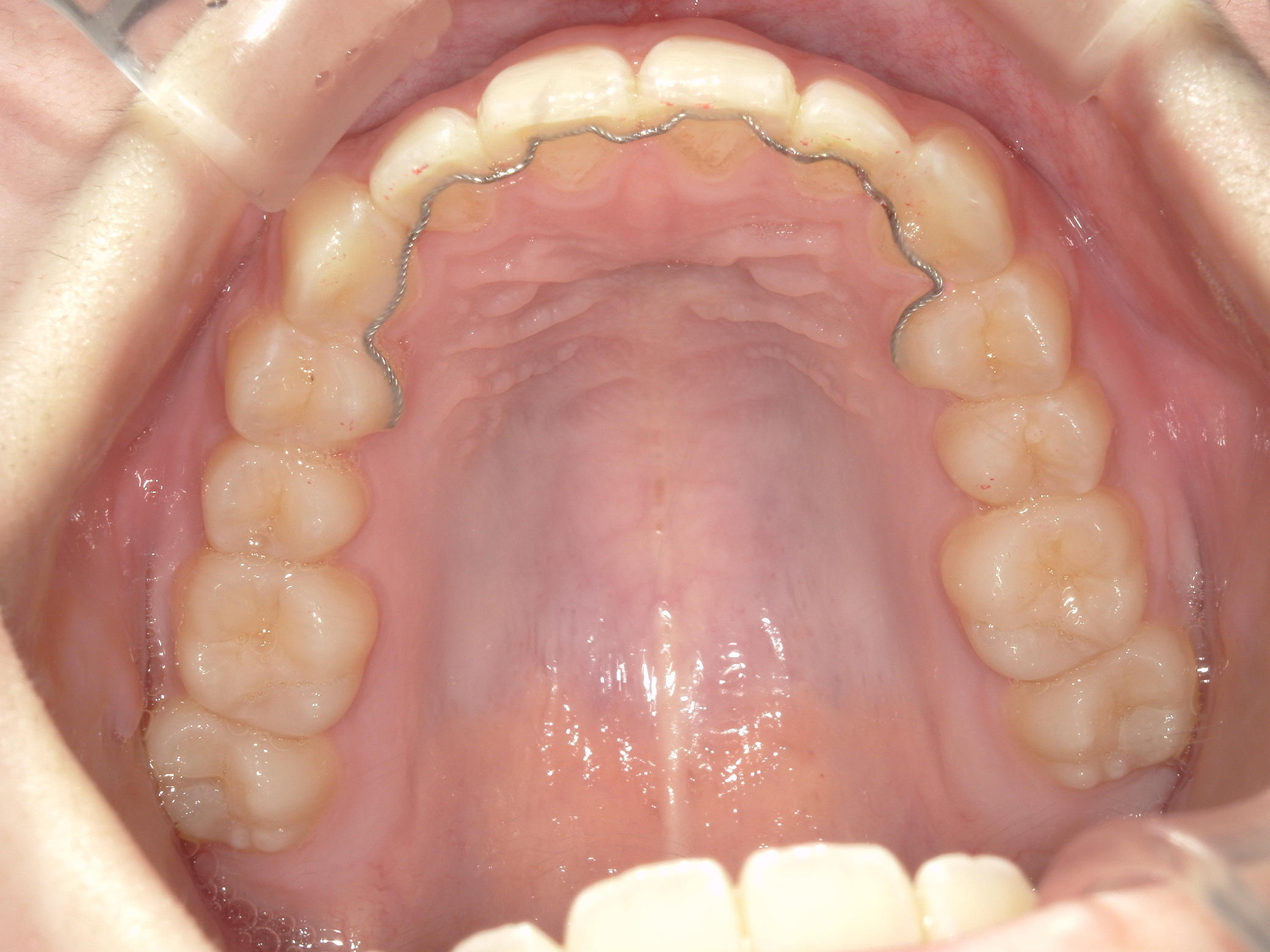 プチワイヤー矯正　症例（55）