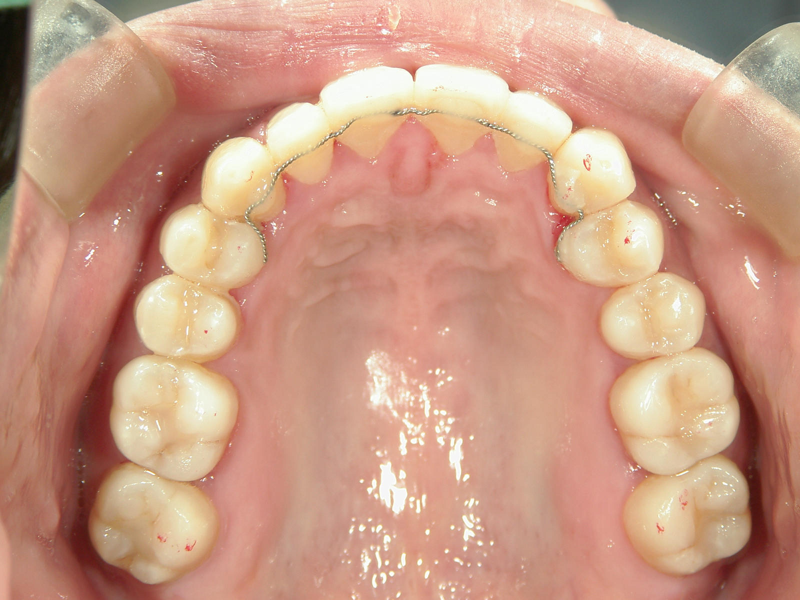 プチワイヤー矯正　症例（56）