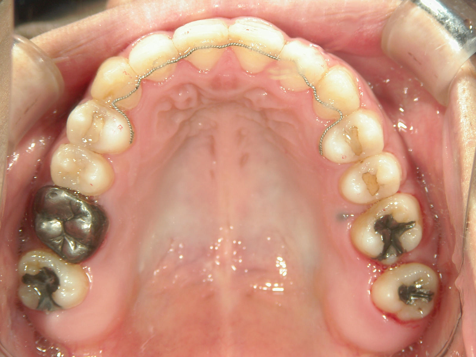 全顎ワイヤー矯正　症例（76）
