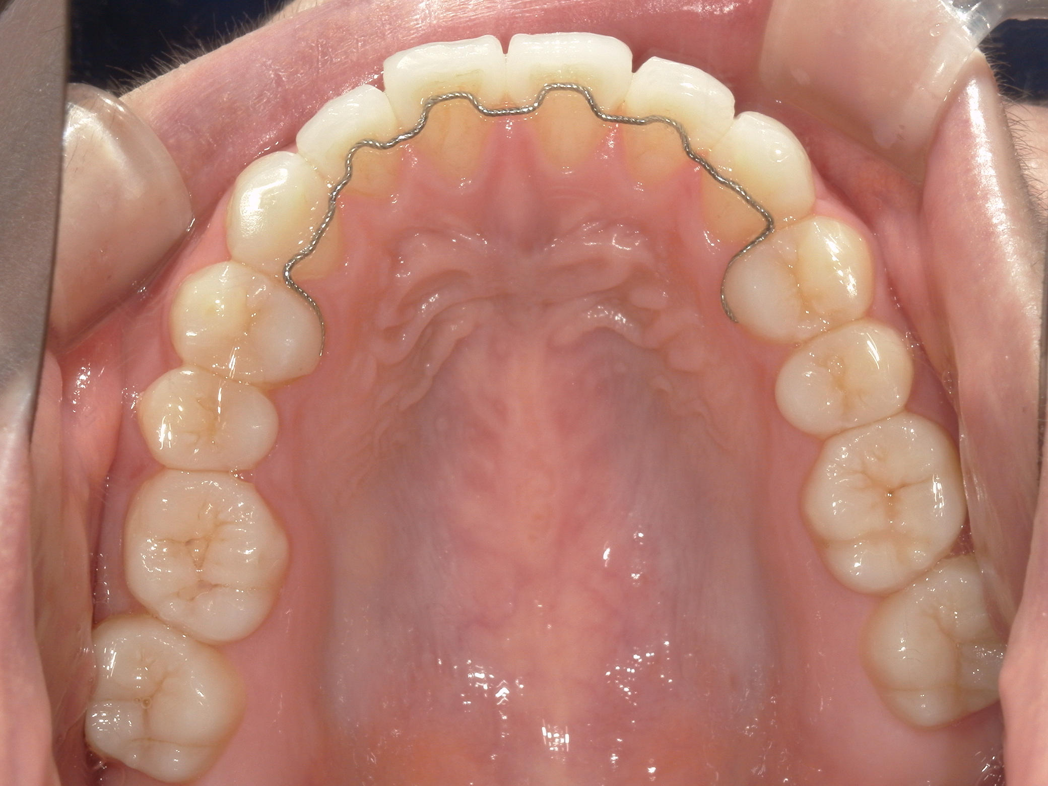 インビザライン矯正(㊤ライト)症例（27）
