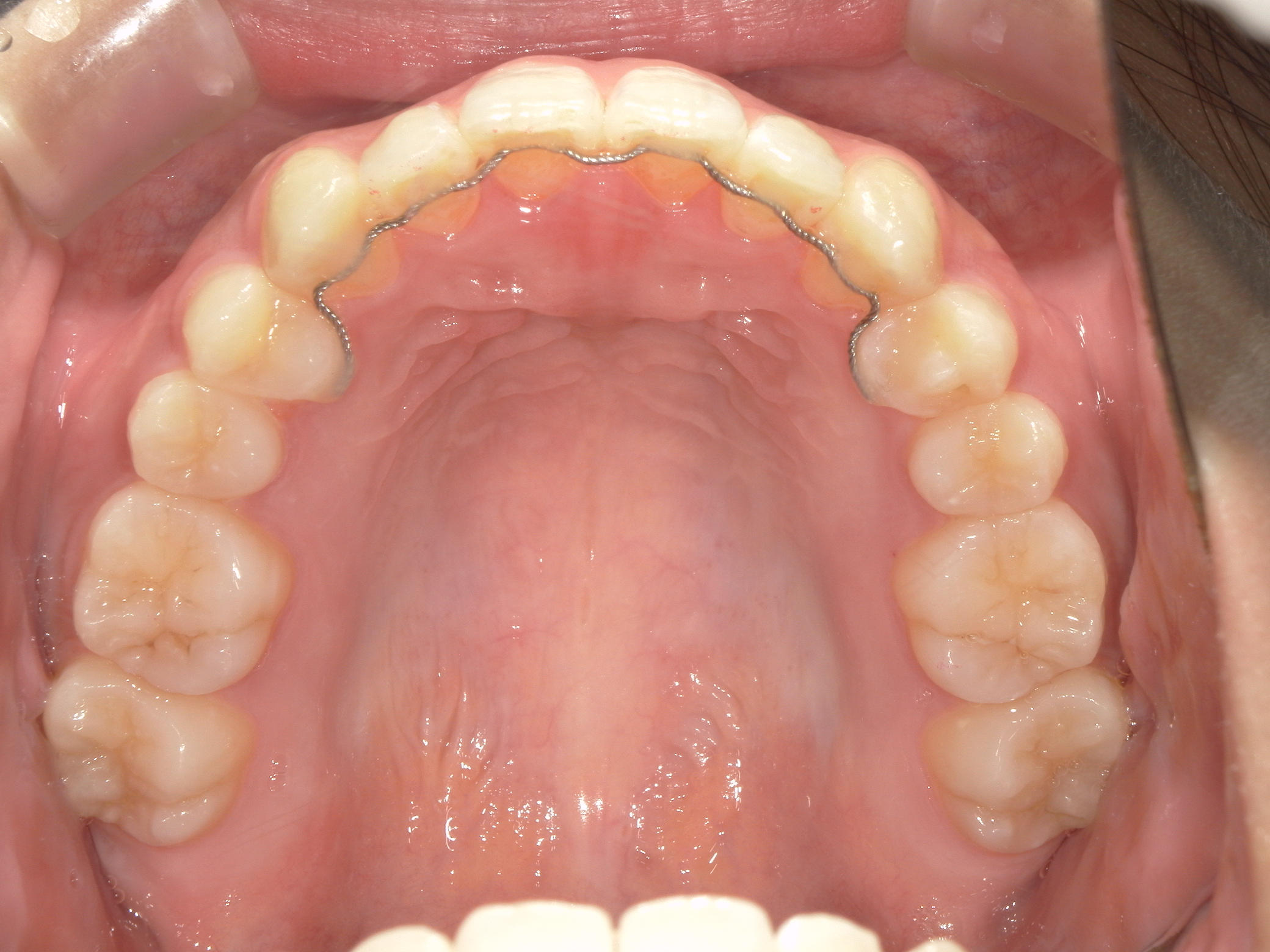 インビザライン(ライト)矯正　症例（28）