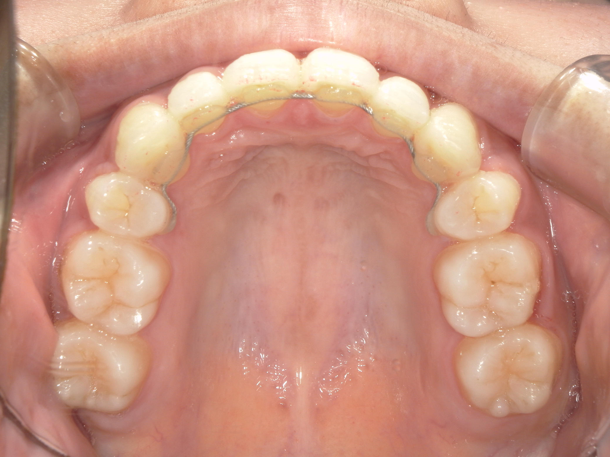 全顎ワイヤー矯正　症例（75）