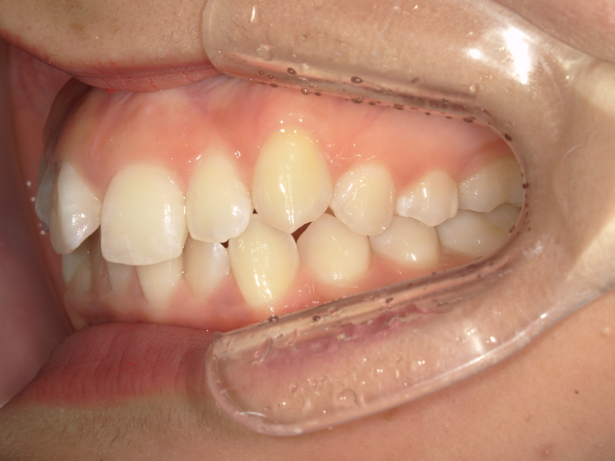 プチワイヤー矯正　症例（54）