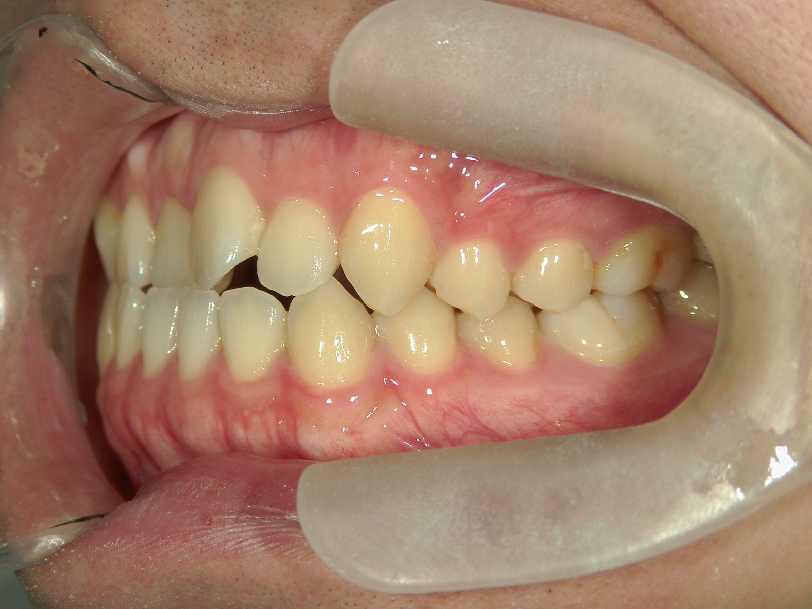 インビザライン矯正　症例（29）