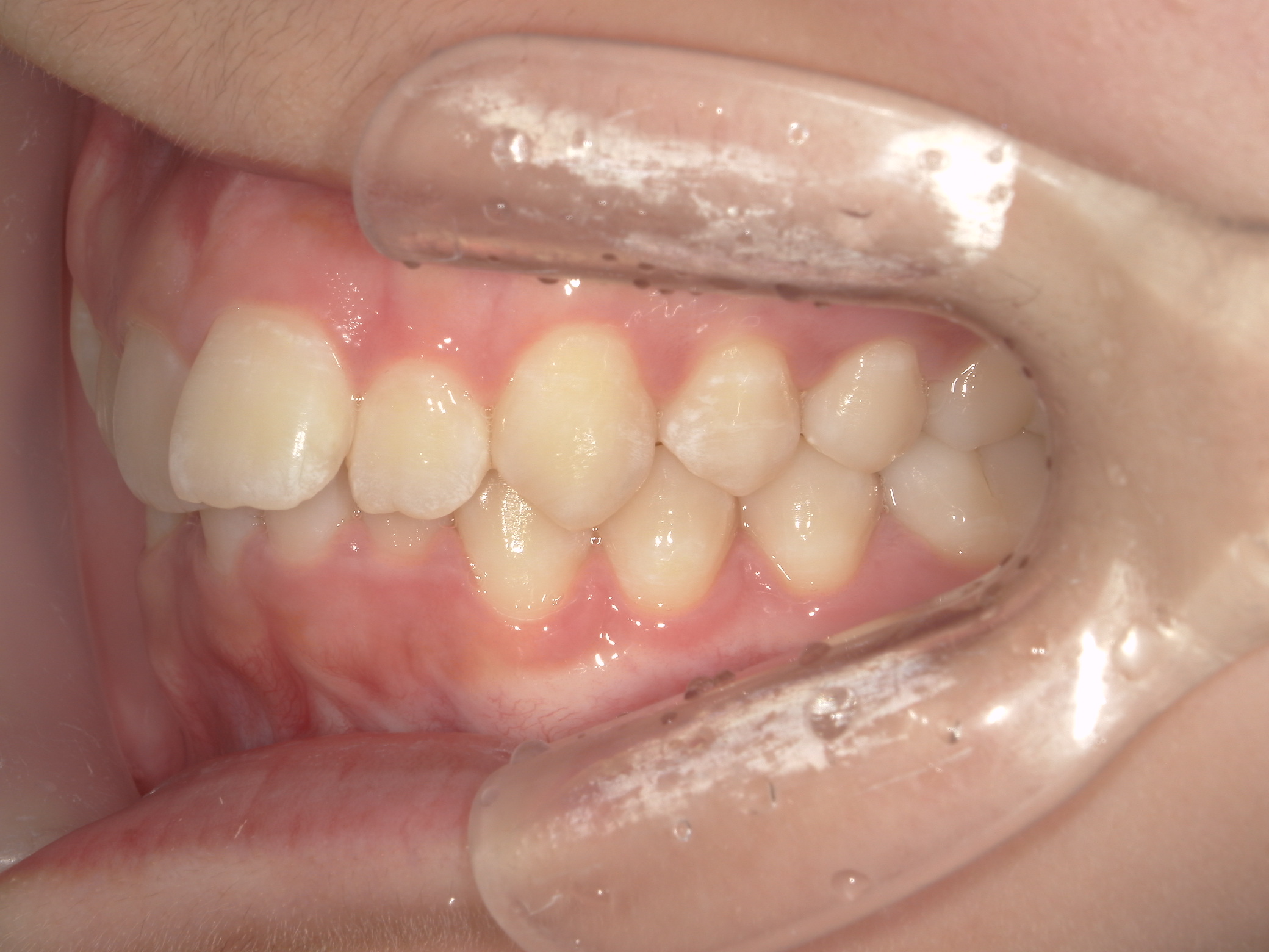 プチワイヤー矯正　症例（55）