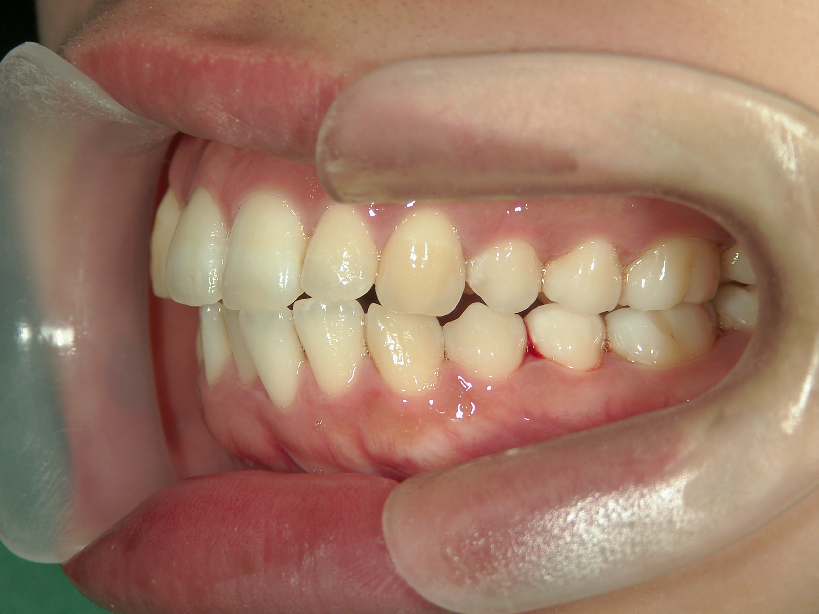 プチワイヤー矯正　症例（56）