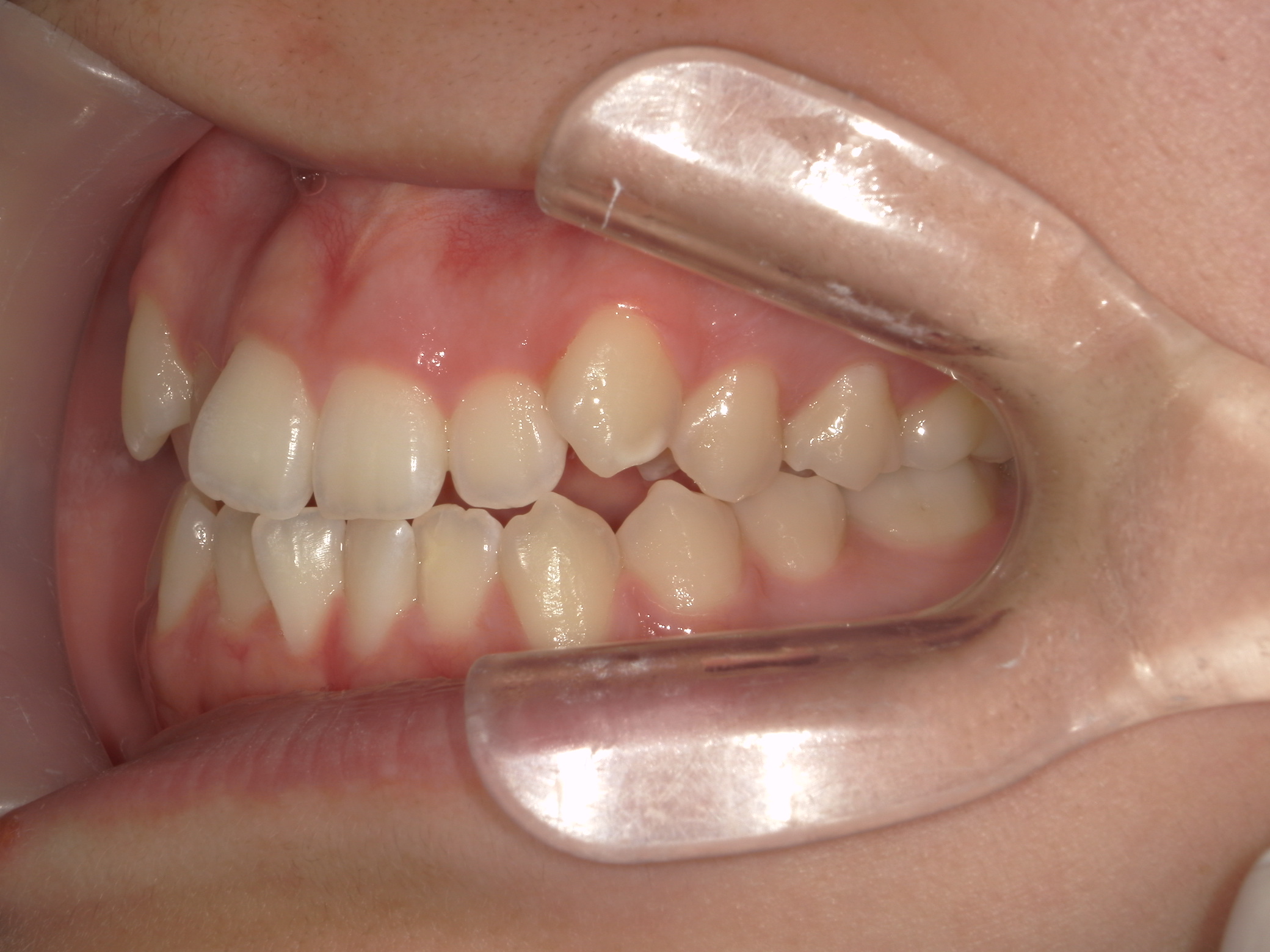 プチワイヤー矯正　症例（57）