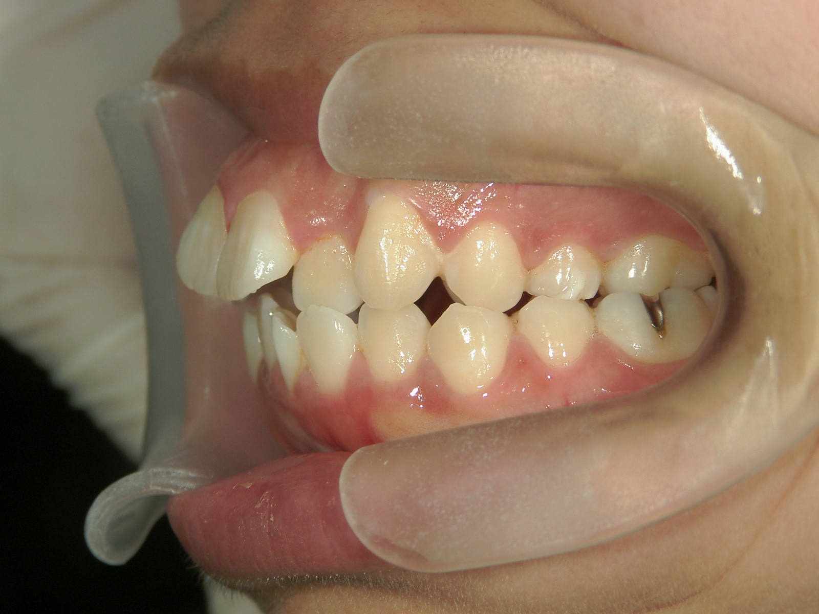 全顎ワイヤー矯正　症例（78）