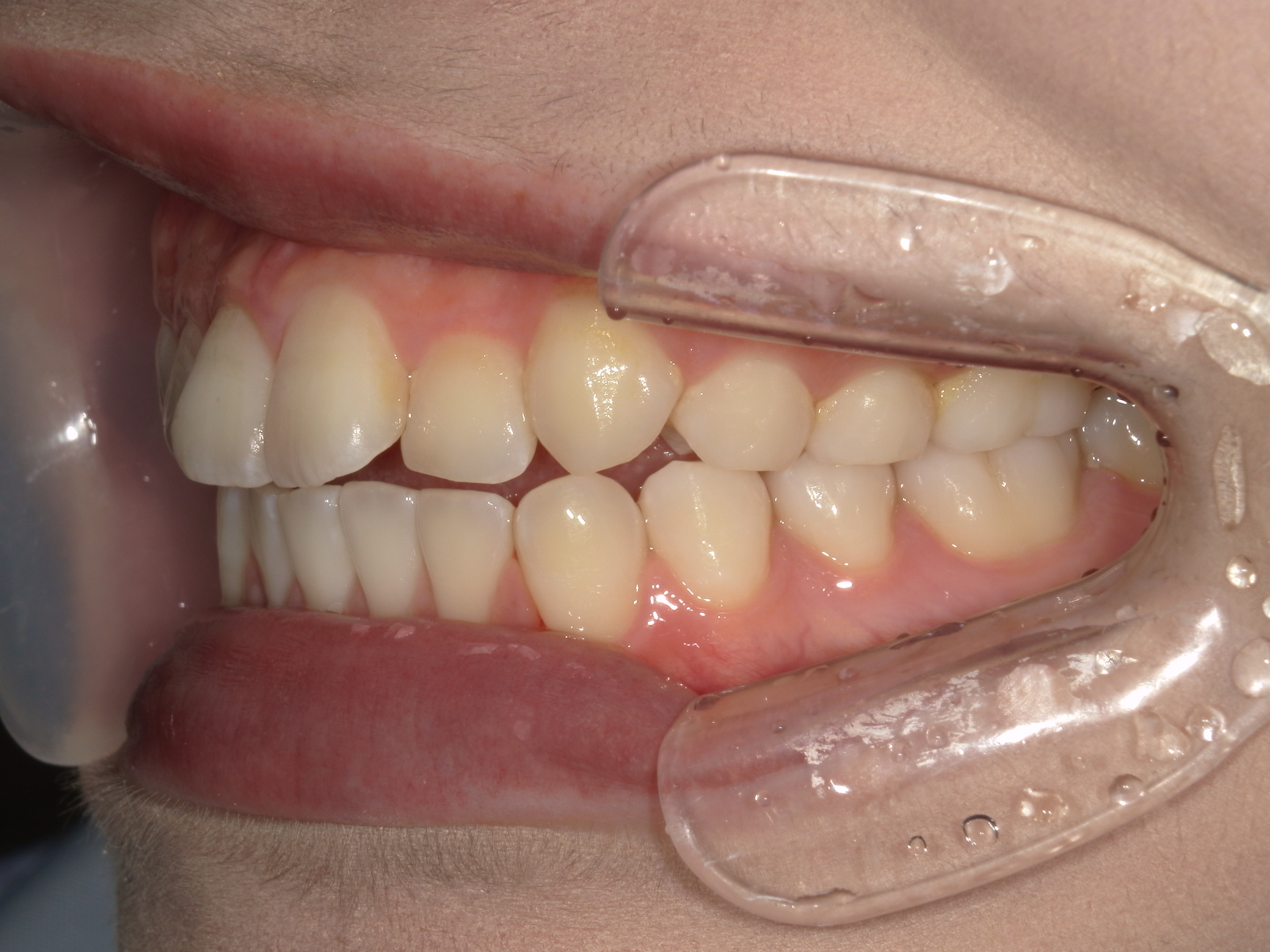 インビザライン矯正(㊤ライト)症例（27）