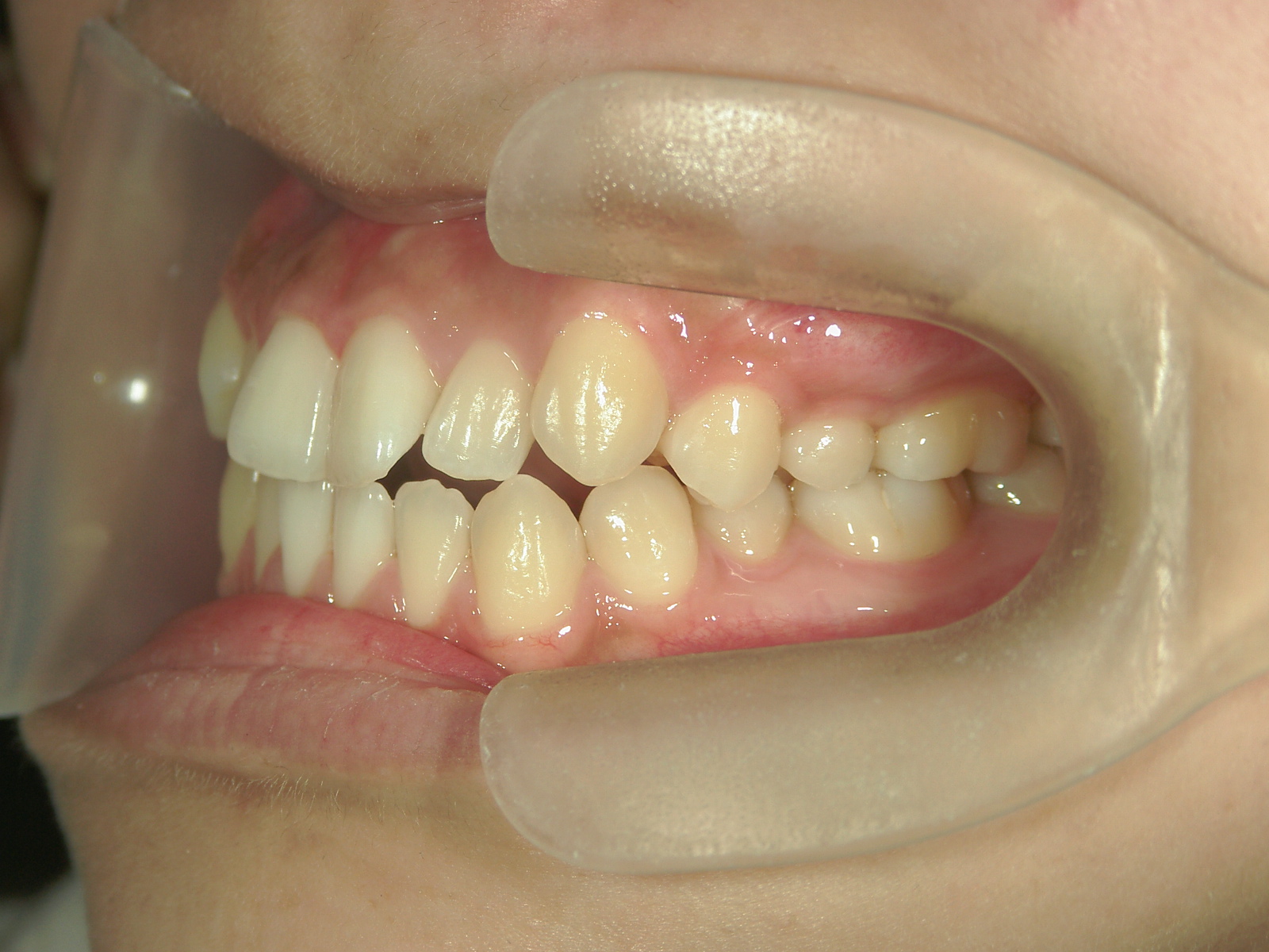 インビザライン(ライト)矯正　症例（28）