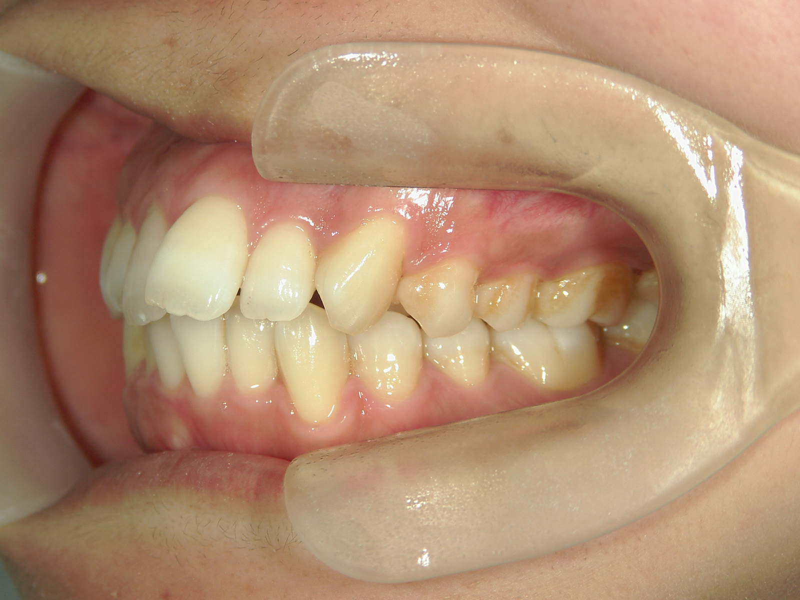 全顎ワイヤー矯正　症例（75）