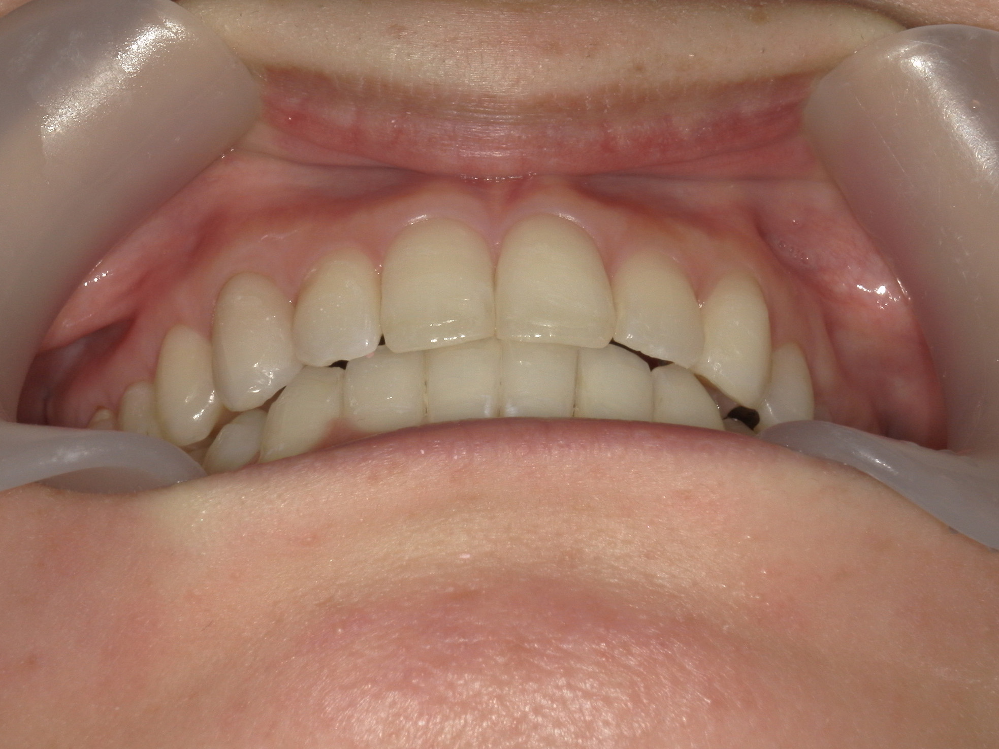 プチワイヤー矯正　症例（51）