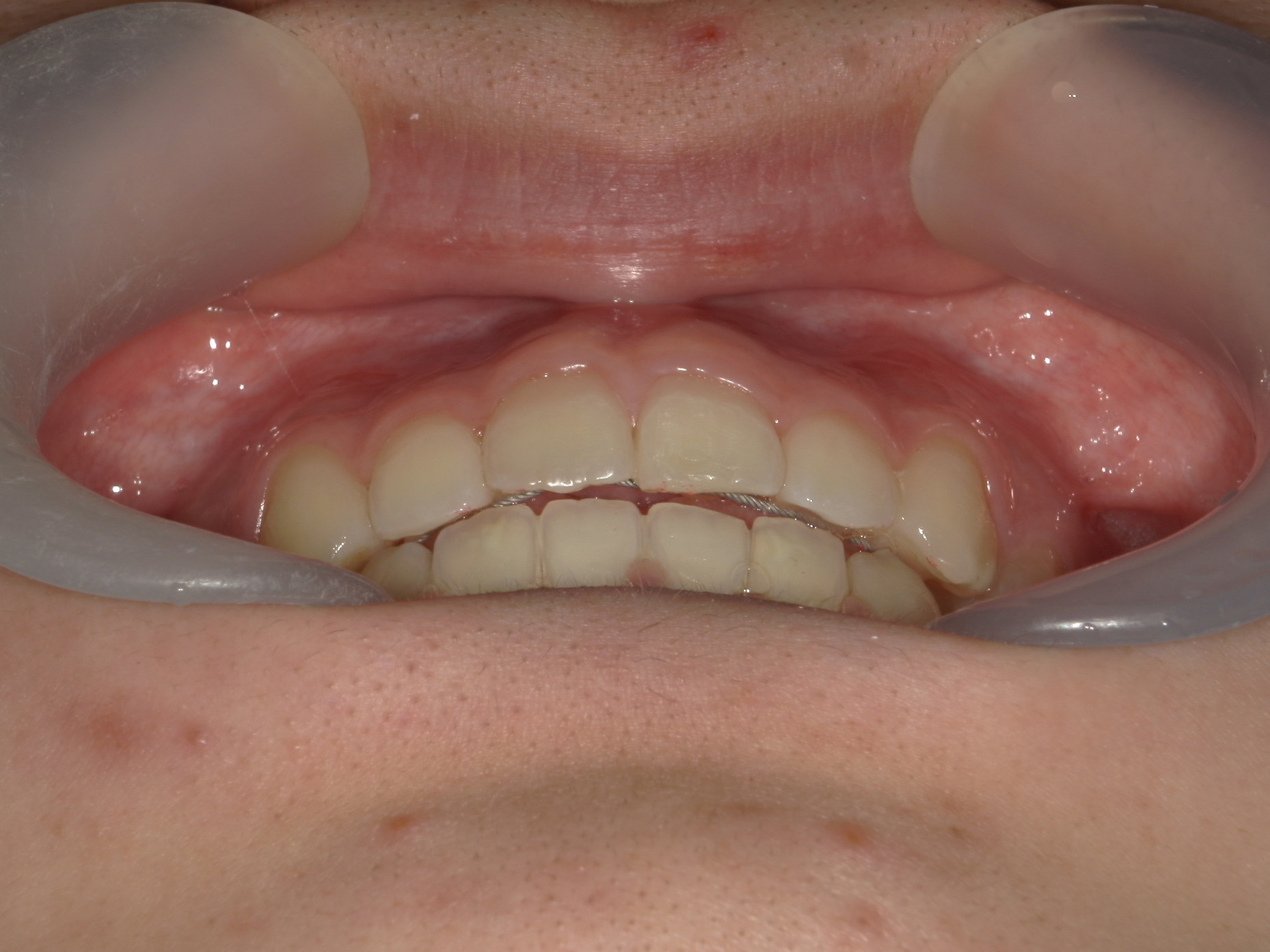 プチワイヤー矯正　症例（57）