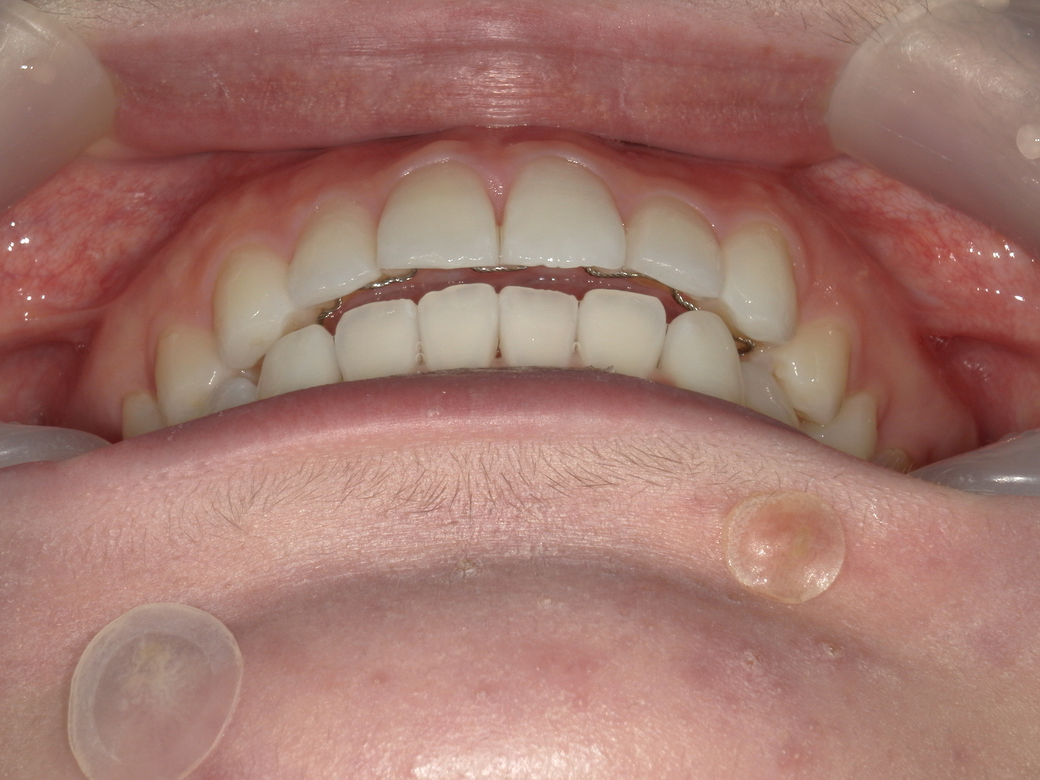 インビザライン矯正(㊤ライト)症例（27）