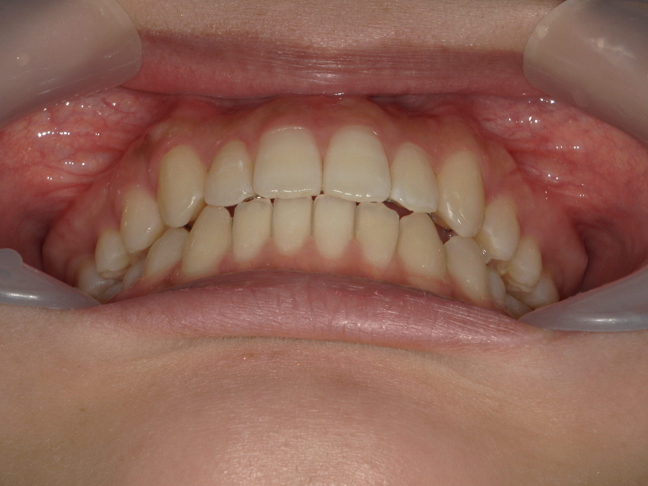 インビザライン(ライト)矯正　症例（28）