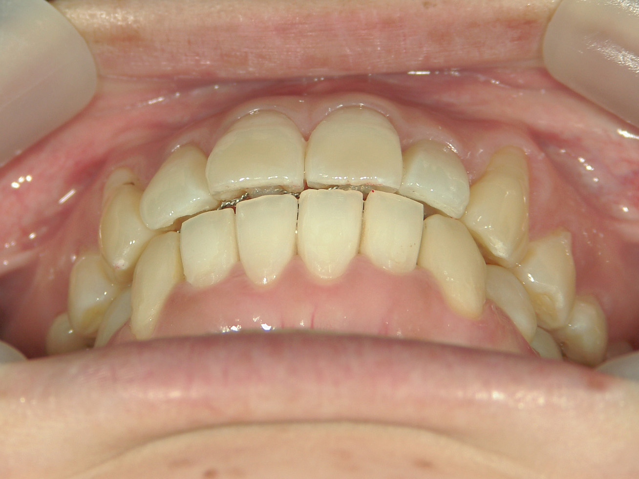 プチワイヤー矯正　症例（53）